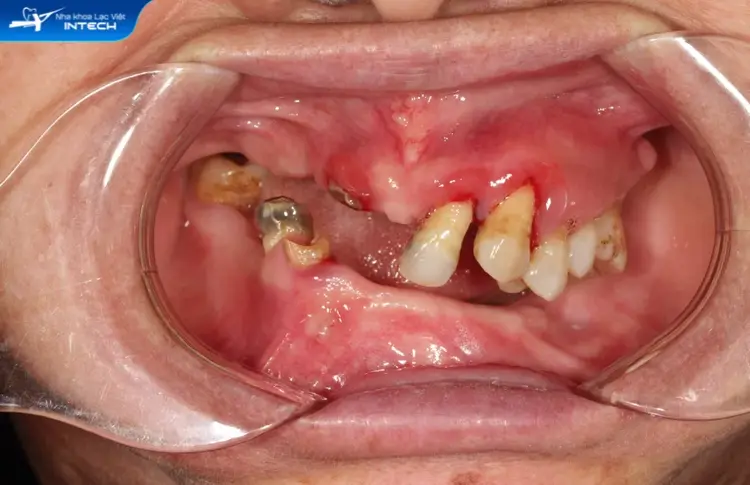 Điều trị các vấn đề về răng miệng có thể khiến chi phí tăng lên