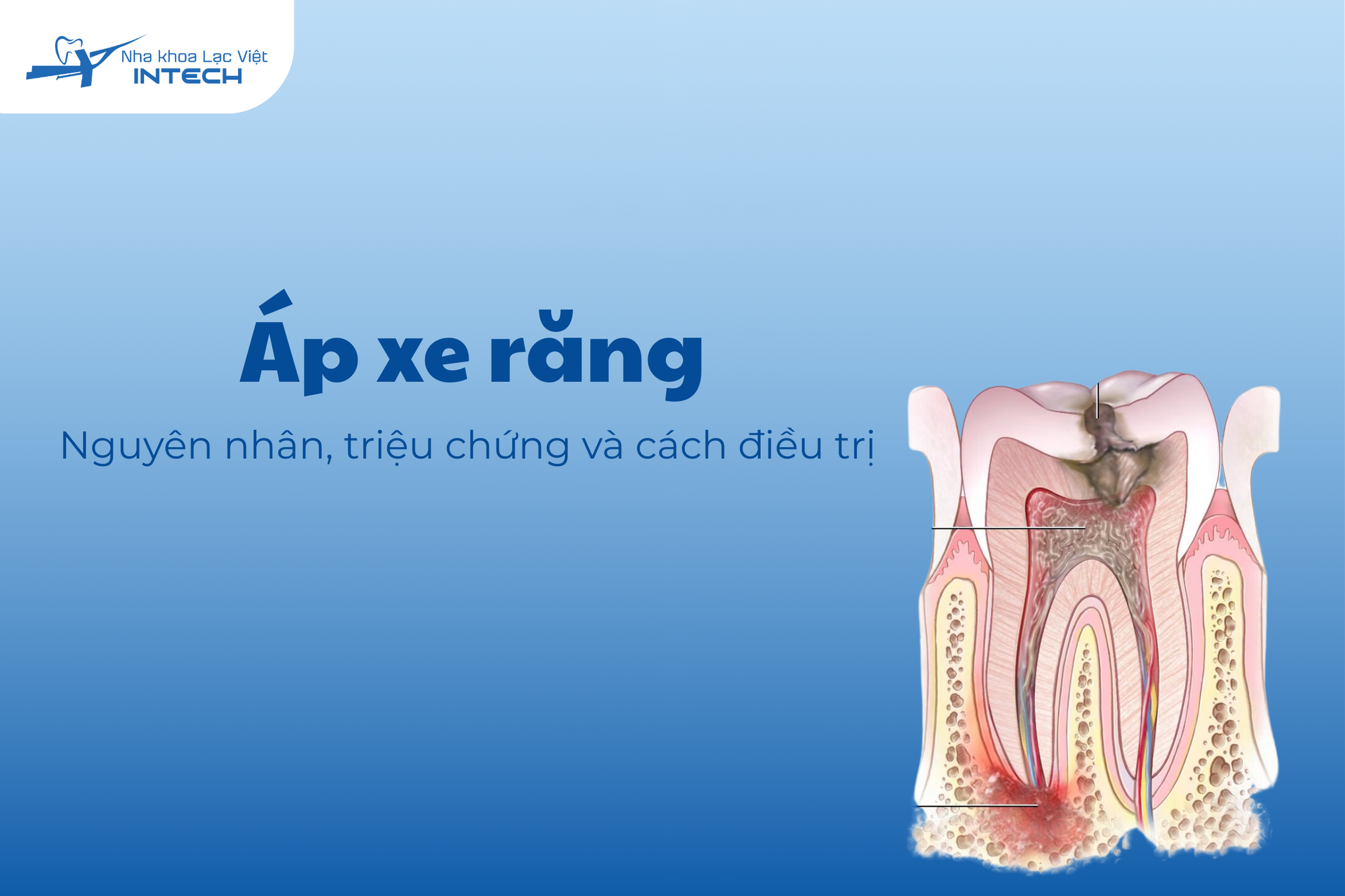 Áp xe răng: Nguyên nhân, triệu chứng và cách điều trị hiệu quả