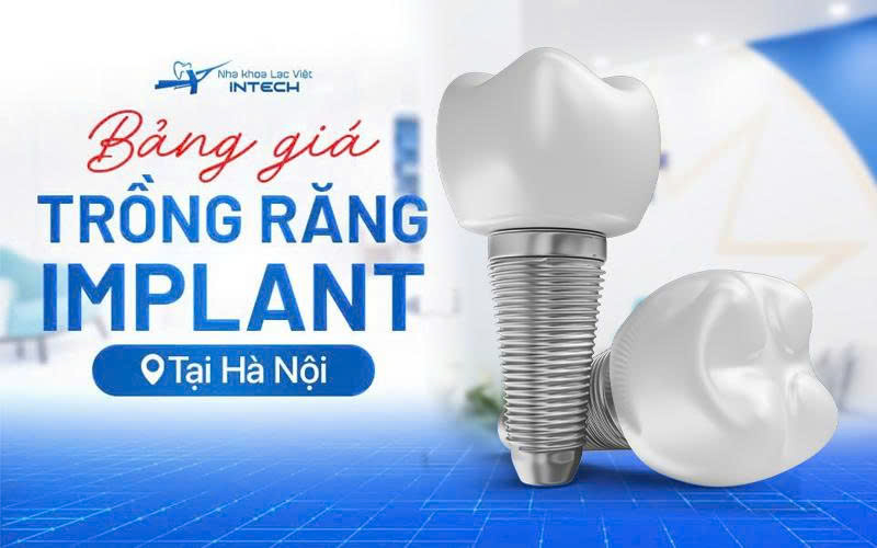 CHƯƠNG TRÌNH KHUYẾN MÃI ĐẶC BIỆT TẠI HÀ NỘI – CHI PHÍ TRỒNG RĂNG IMPLANT
