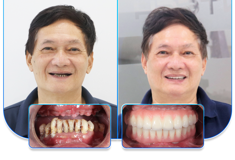 Nha khoa Lạc Việt Intech - Trung tâm trồng răng implant và chỉnh nha chuyên sâu