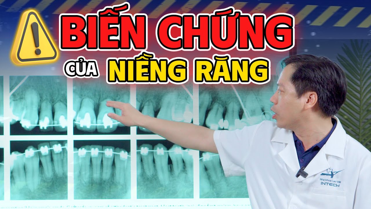 3 biến chứng cực kỳ nguy hiểm khi niềng răng