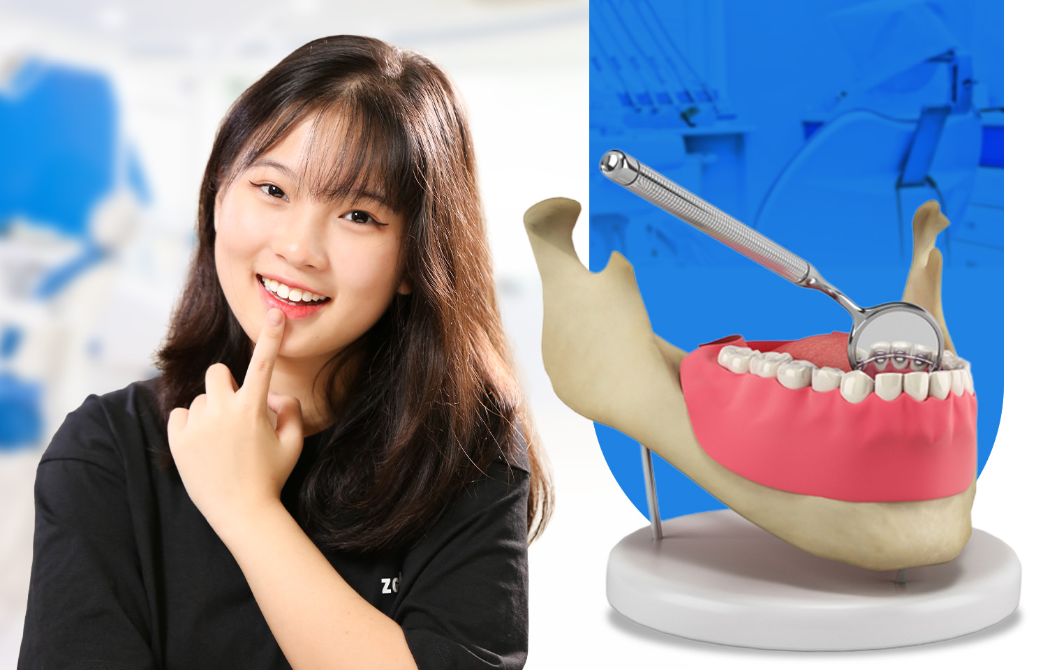 Niềng răng mắc cài mặt trong 