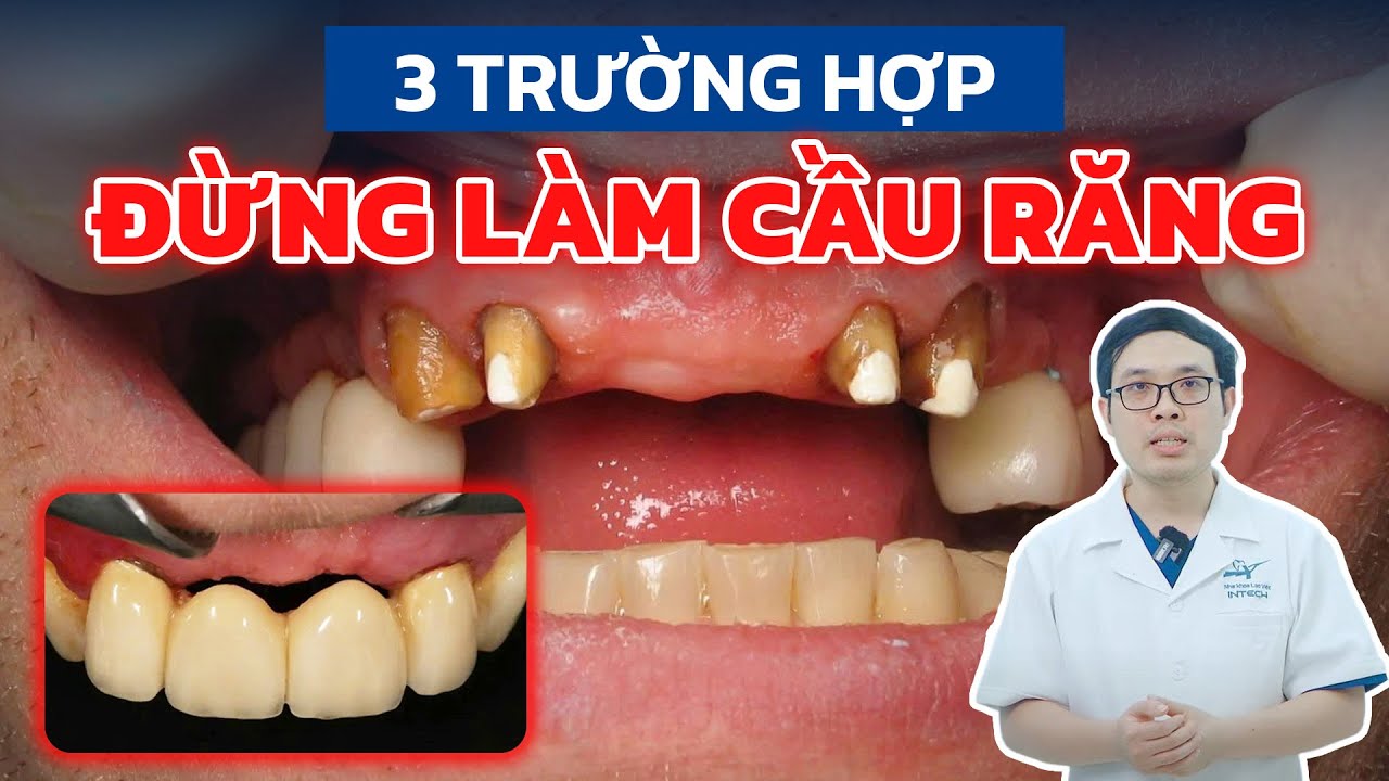 Cầu Răng Sứ: 3 Trường Hợp ĐỪNG Làm Cầu Răng Sứ – Cảnh Báo Trước Khi Quá Muộn!