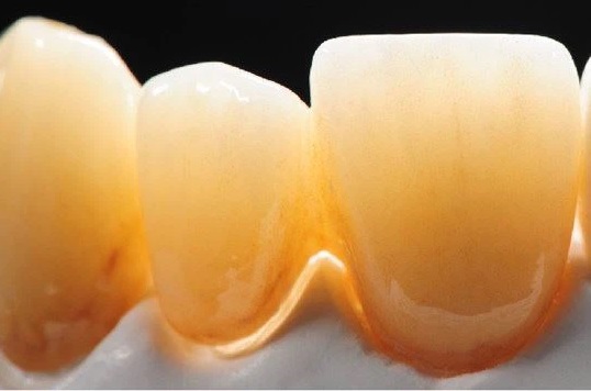Các tiêu chí đánh giá chất lượng một loại răng sứ