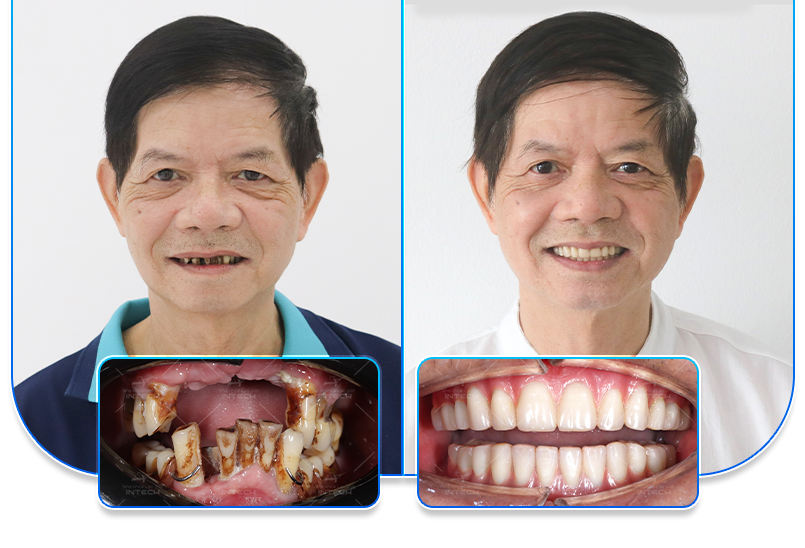 Nha khoa Lạc Việt Intech - Trung tâm trồng răng implant và chỉnh nha chuyên sâu