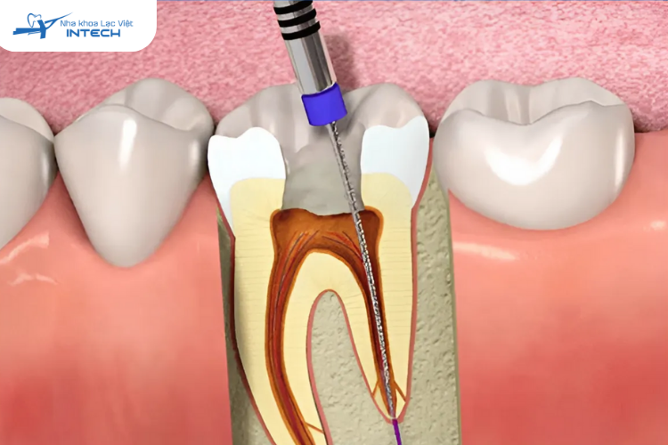 Điều trị tuỷ răng giúp bảo tồn răng thật, phục hồi chức năng ăn nhai, giữ gìn thẩm mỹ và bảo vệ cấu trúc xương hàm