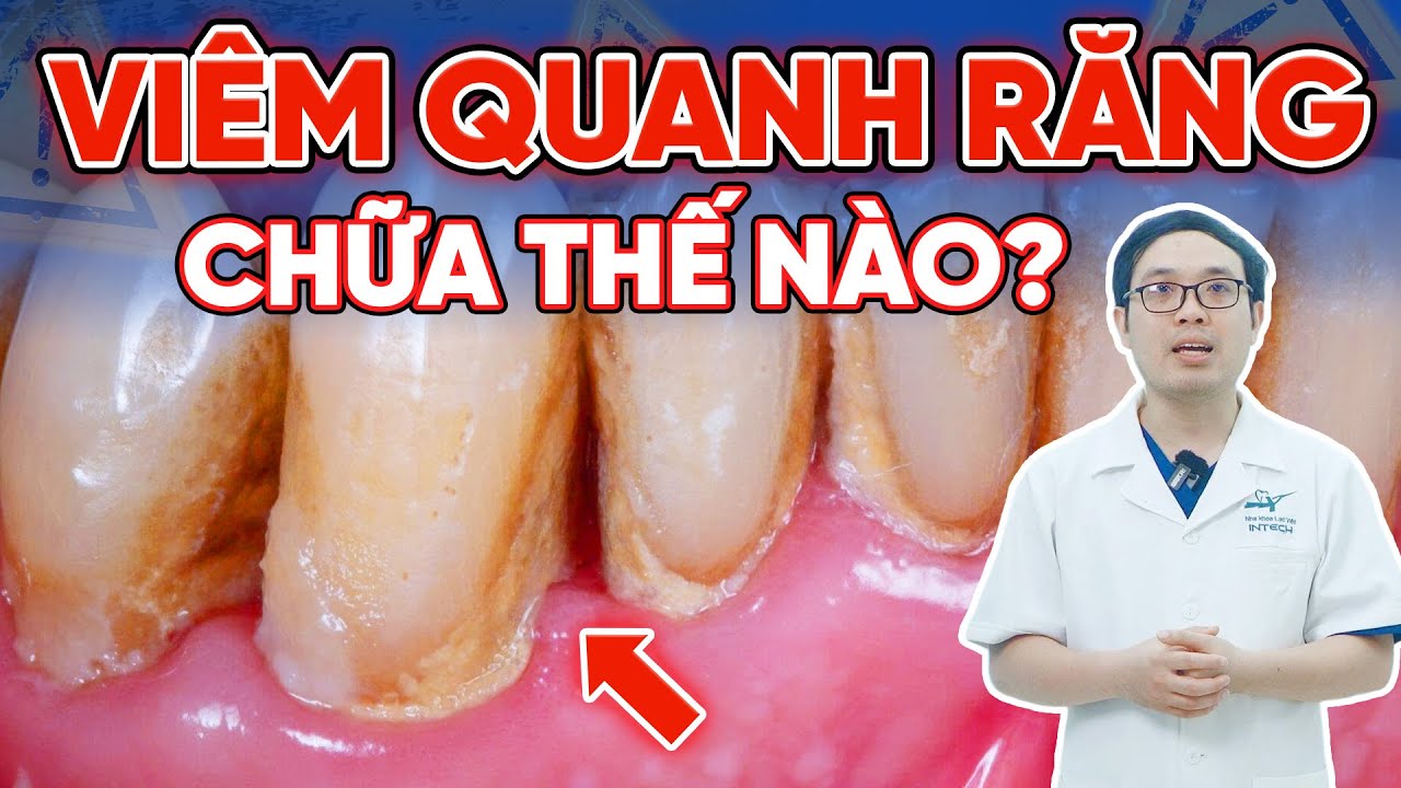 Cảnh báo: Trên 90% người trưởng thành bị viêm quanh răng mà không hề hay biết