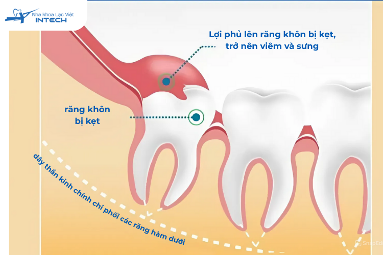 Răng khôn mọc lệch khiến lợi sưng lên và viêm