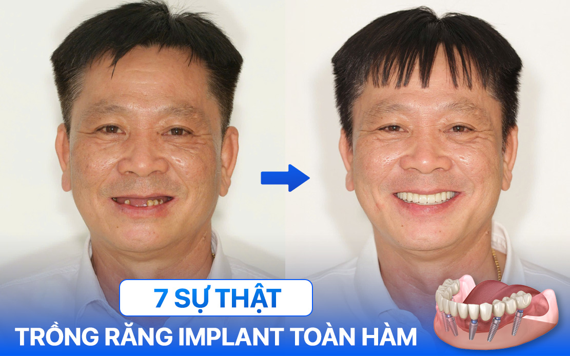Trồng răng Implant toàn hàm: 7+ sự thật bác sĩ luôn nhắc trước khi làm