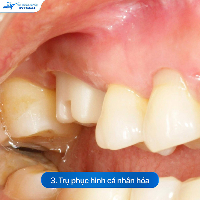 Trụ phục hình cá nhân hóa giống đúc thân răng thật