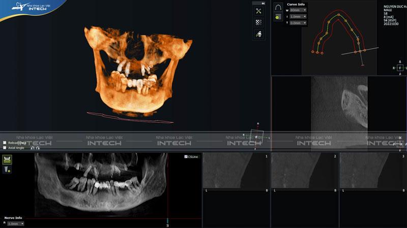 Hình ảnh phim chụp CT của chú Hà sau khi cấy ghép 6 trụ Implant hàm trên