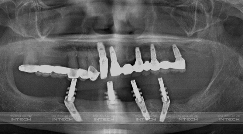 Ảnh phim chụp X-quang của bác Phương sau trồng răng All On 4 hàm dưới