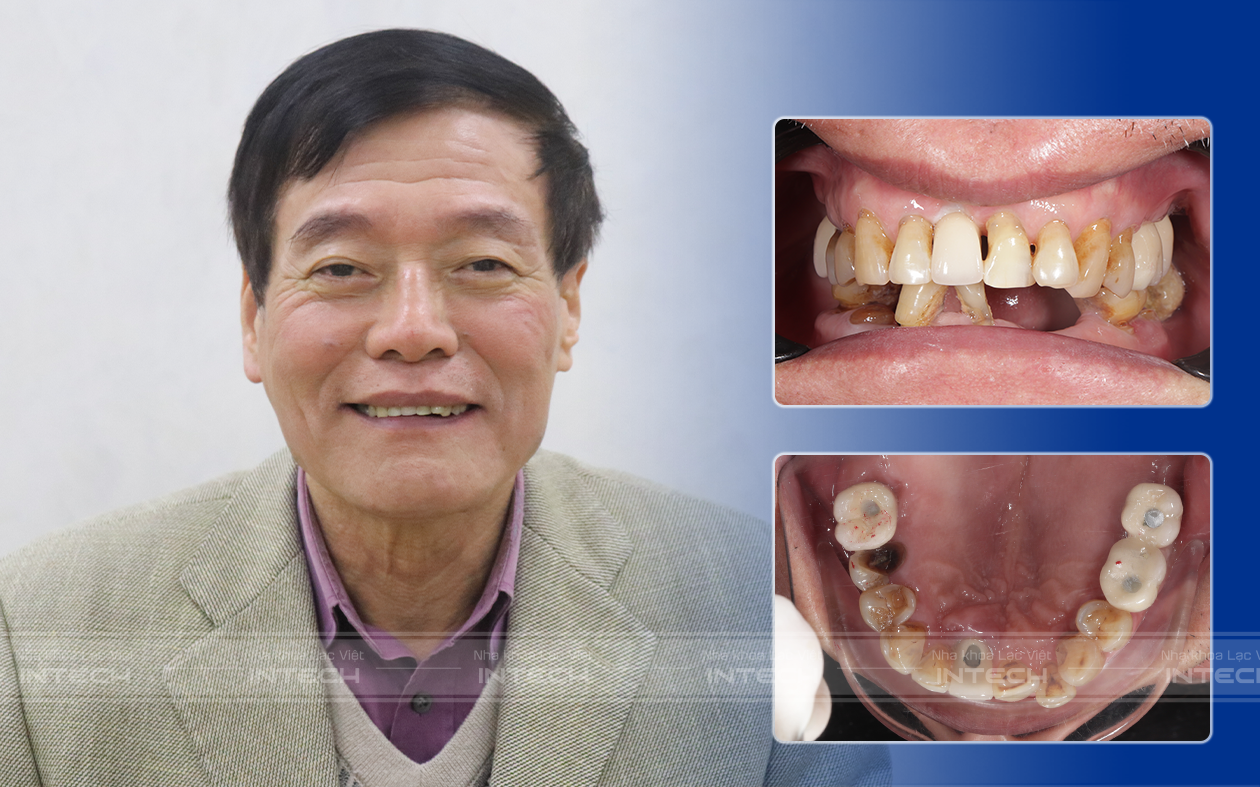 Hình ảnh chú Nguyễn Trà Lý trong buổi lắp răng hàm trên