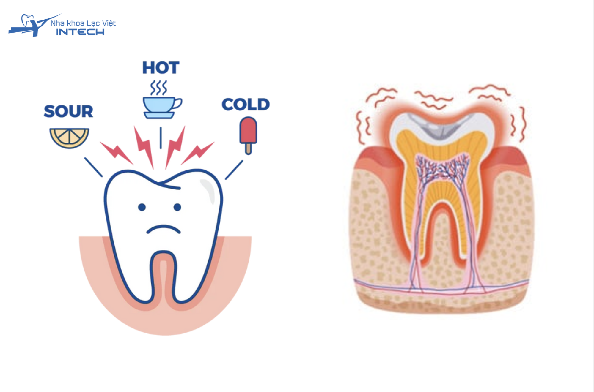 Răng xuất hiện cảm giác đau nhói, ê buốt khó chịu khi tiếp xúc với các yếu tố kích thích từ bên ngoài