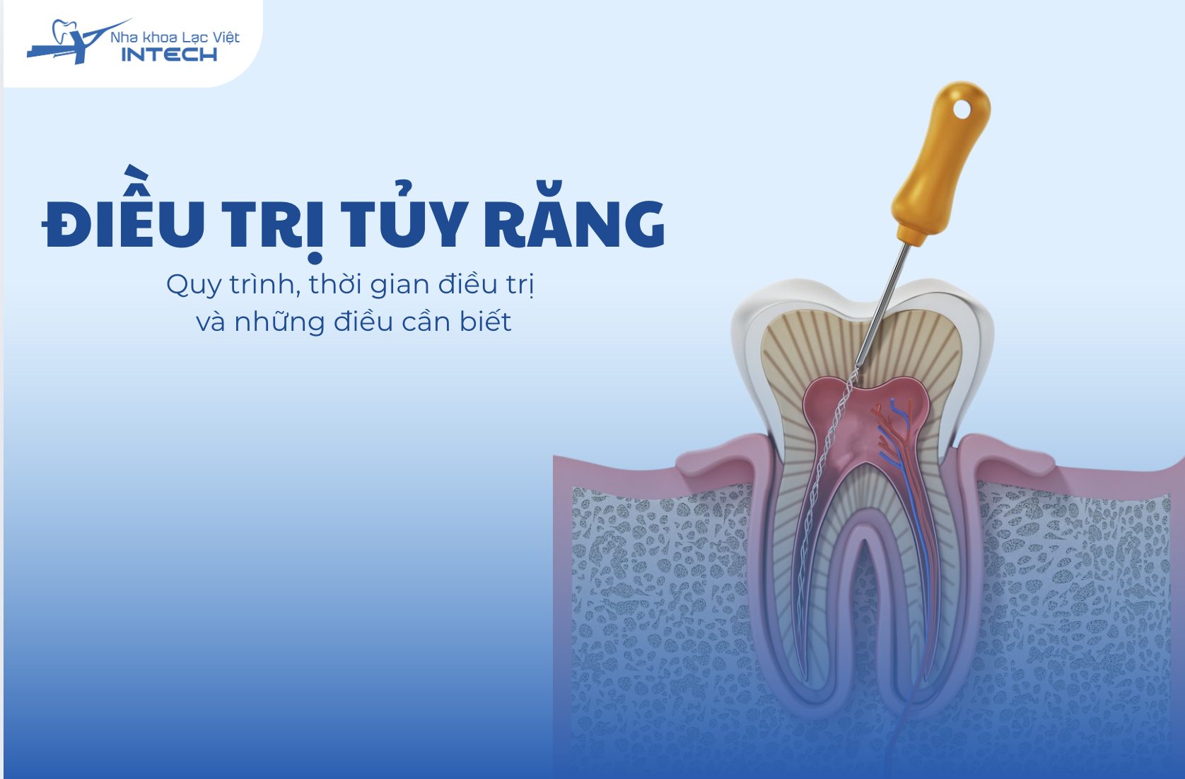 Điều trị tủy răng: Thời gian điều trị và các yếu tố ảnh hưởng