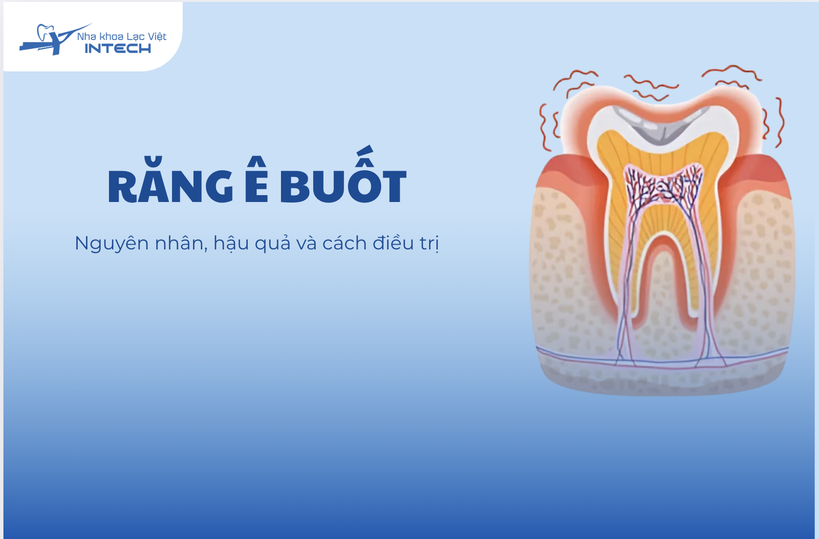 Răng ê buốt: Nguyên nhân, hậu quả và cách điều trị dứt điểm