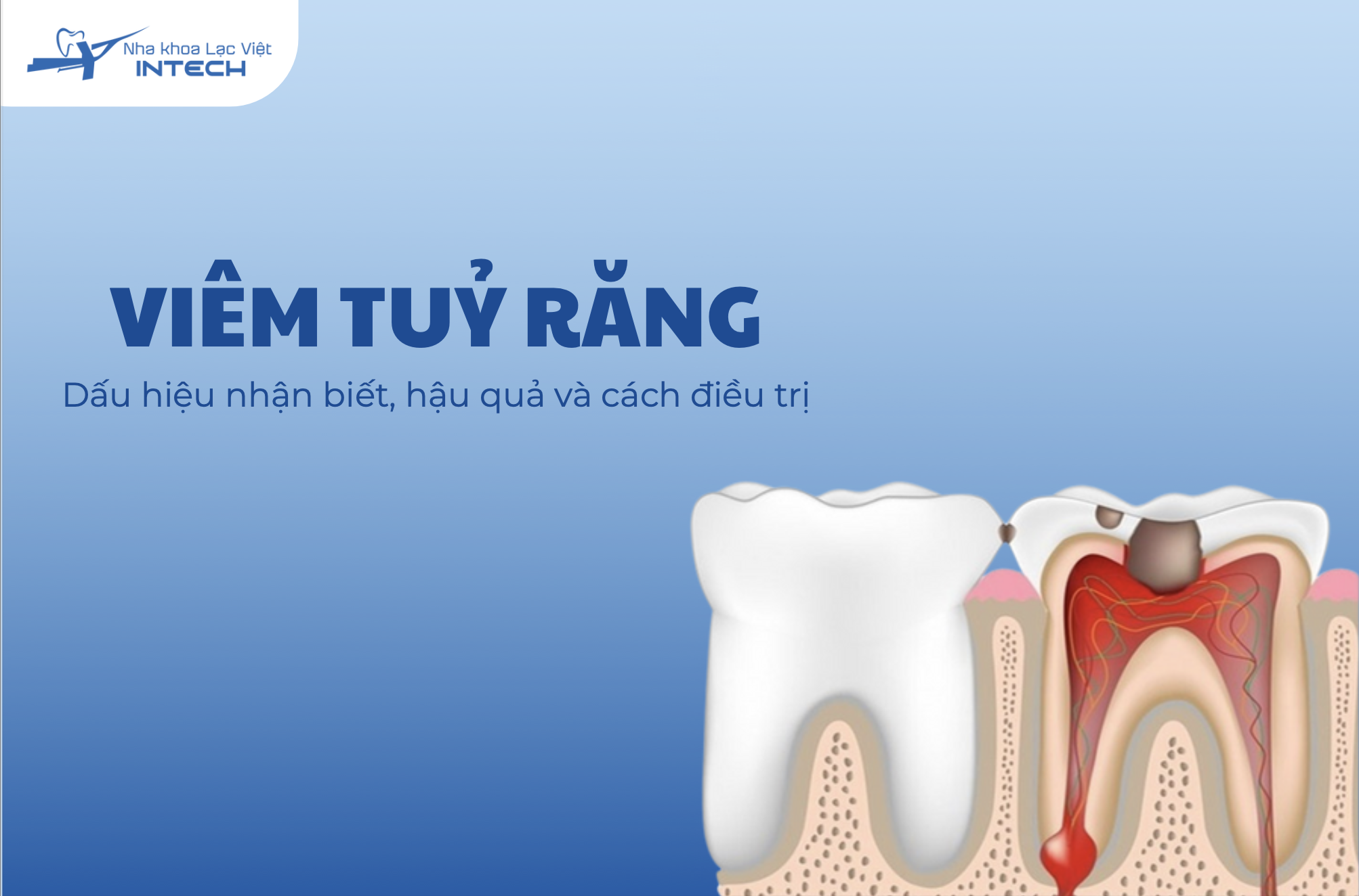 Viêm tủy răng: Các dấu hiệu nhận biết, hậu quả và cách điều trị