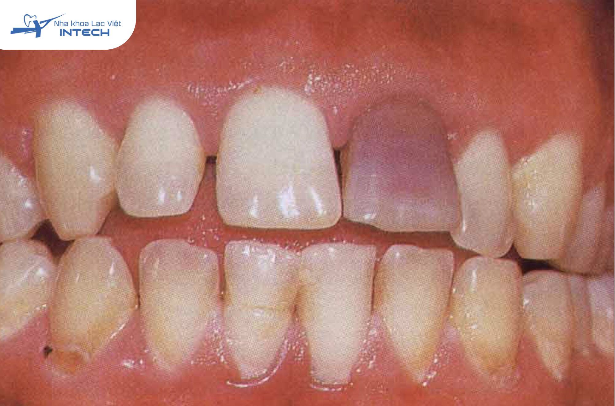 Răng thay đổi màu một cách rõ rệt