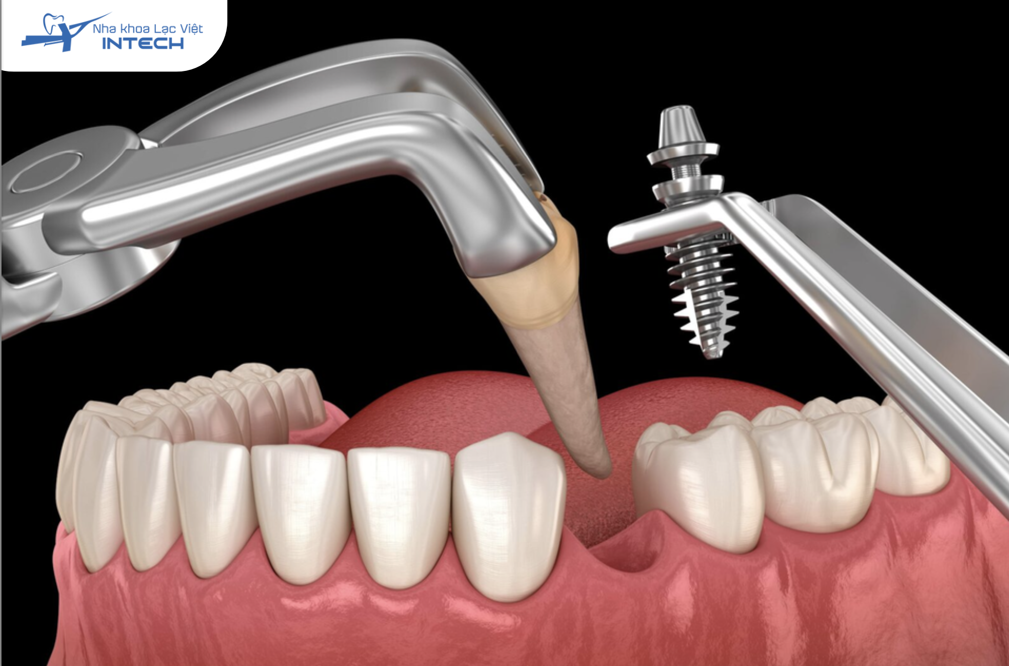 Nhổ bỏ răng và sử dụng răng Implant thay thế
