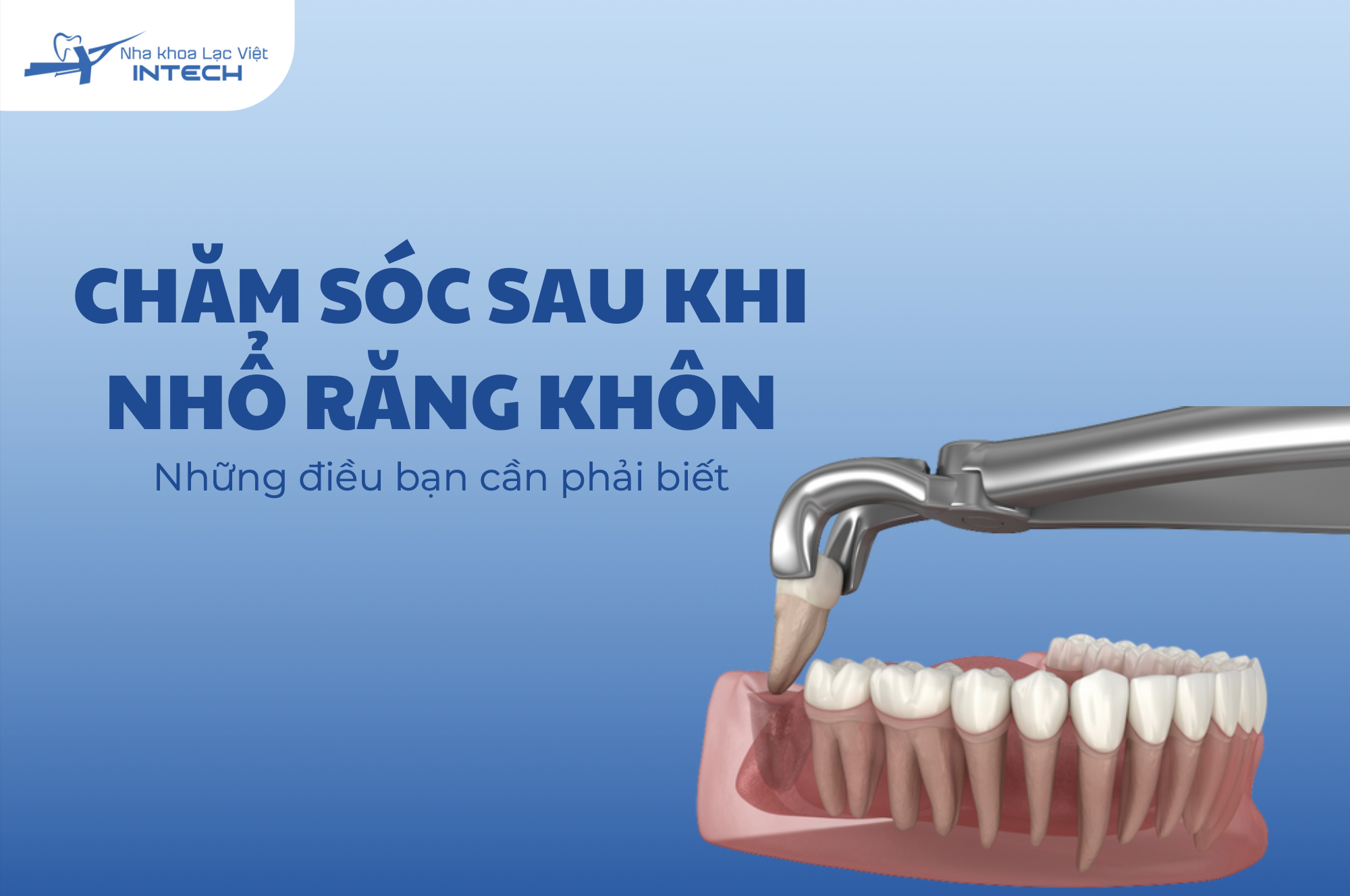 Chăm sóc sau khi nhổ răng khôn: Làm gì để hồi phục nhanh? 