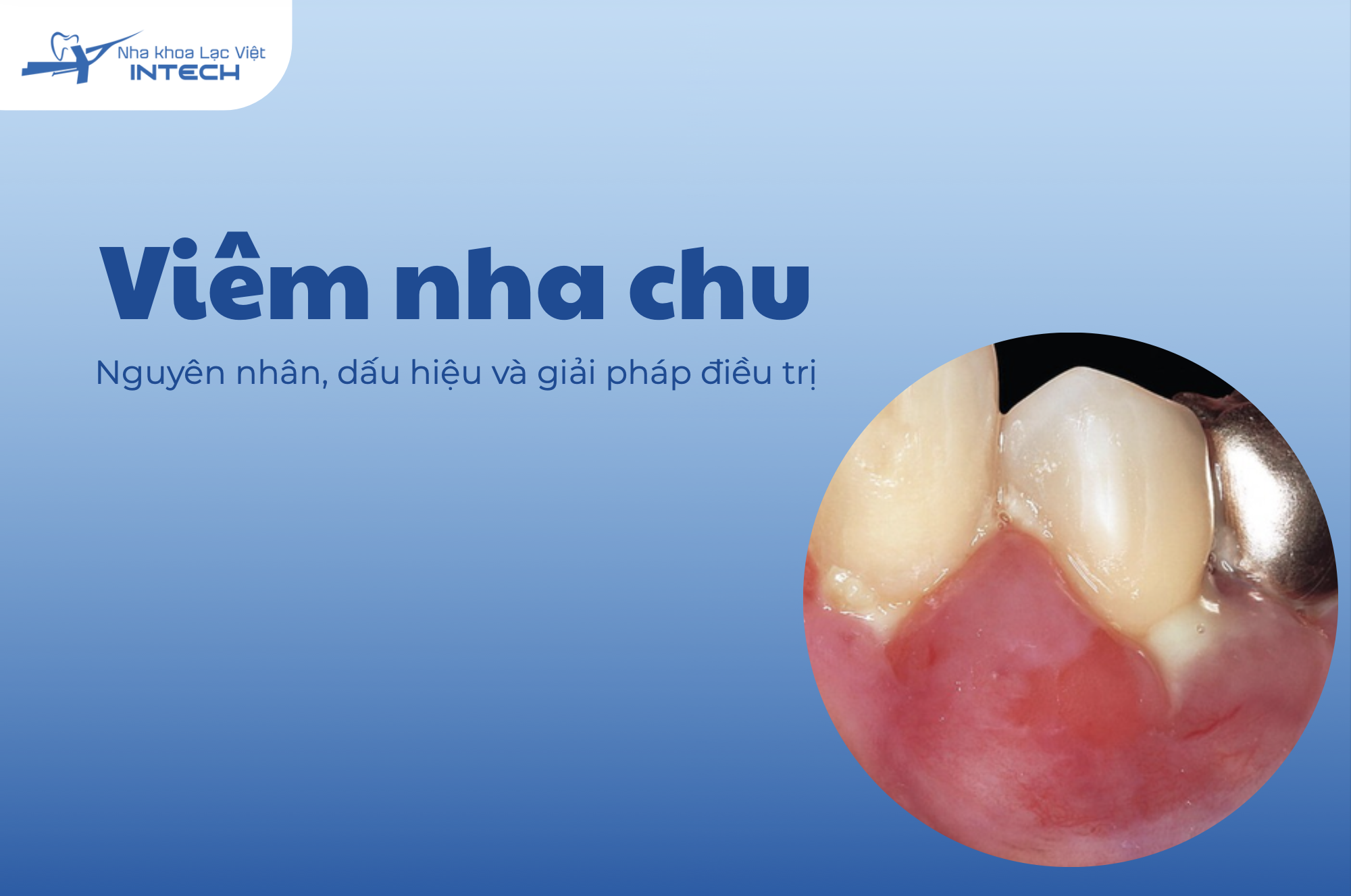 Viêm nha chu: Nguyên nhân, dấu hiệu và giải pháp điều trị 