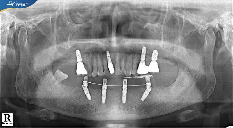 Hình ảnh phim CT của chú Lý sau khi cấy ghép Implant All On 4 toàn hàm dưới