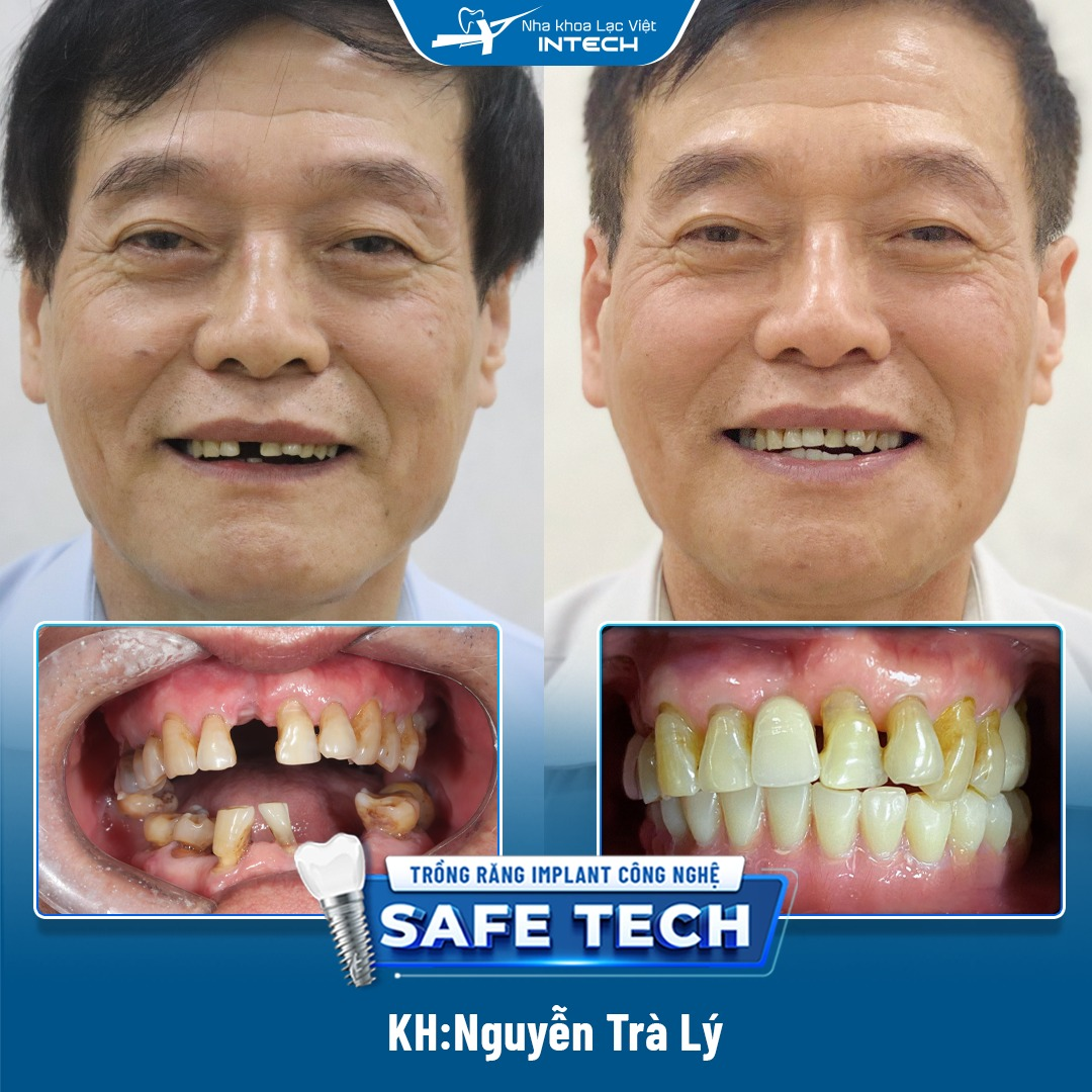 Hình ảnh trước và sau khi trồng răng Implant của chú Trà Lý