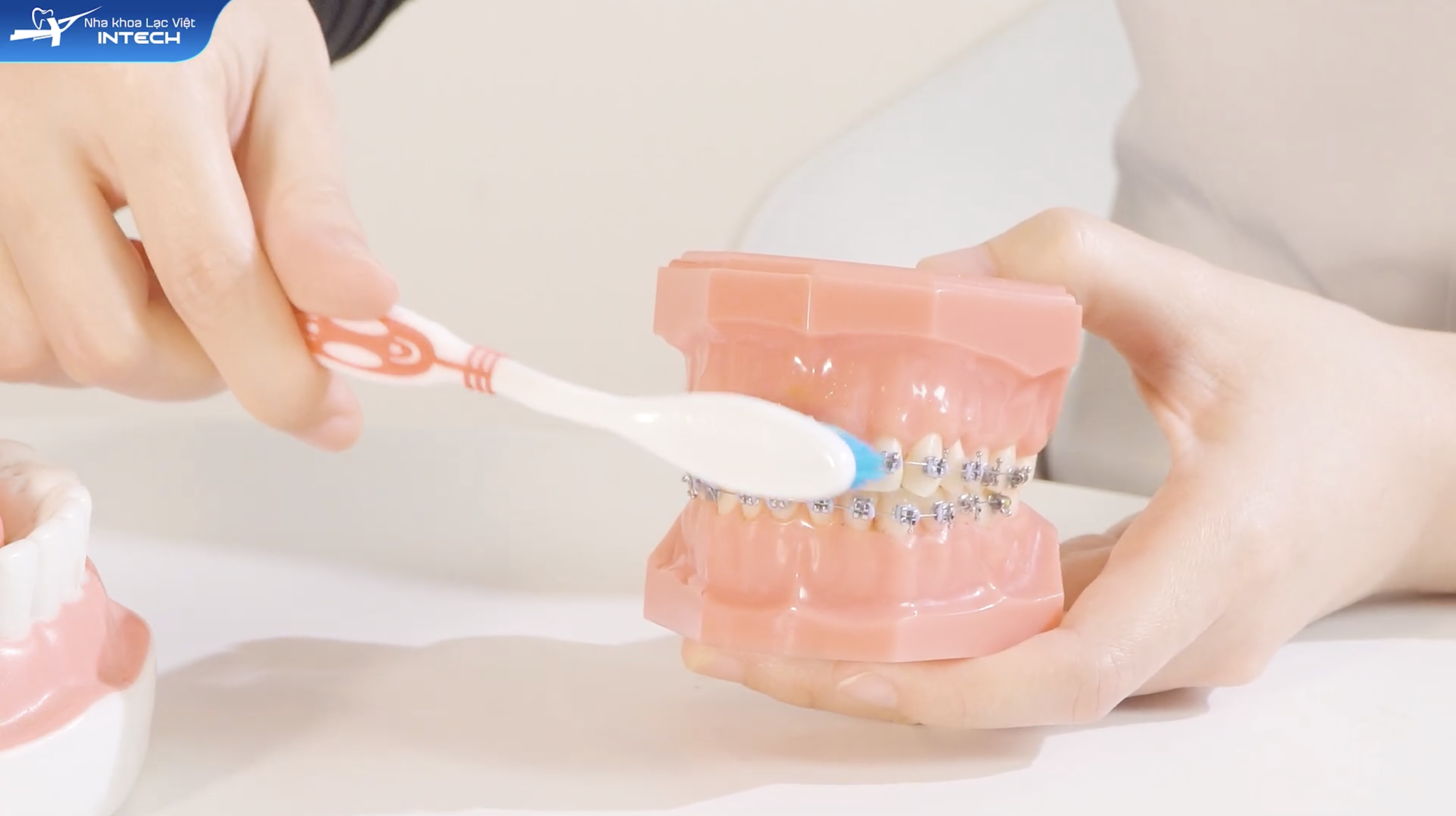 Vệ sinh răng miệng đúng cách là bắt buộc để tránh hôi miệng khi niềng răng
