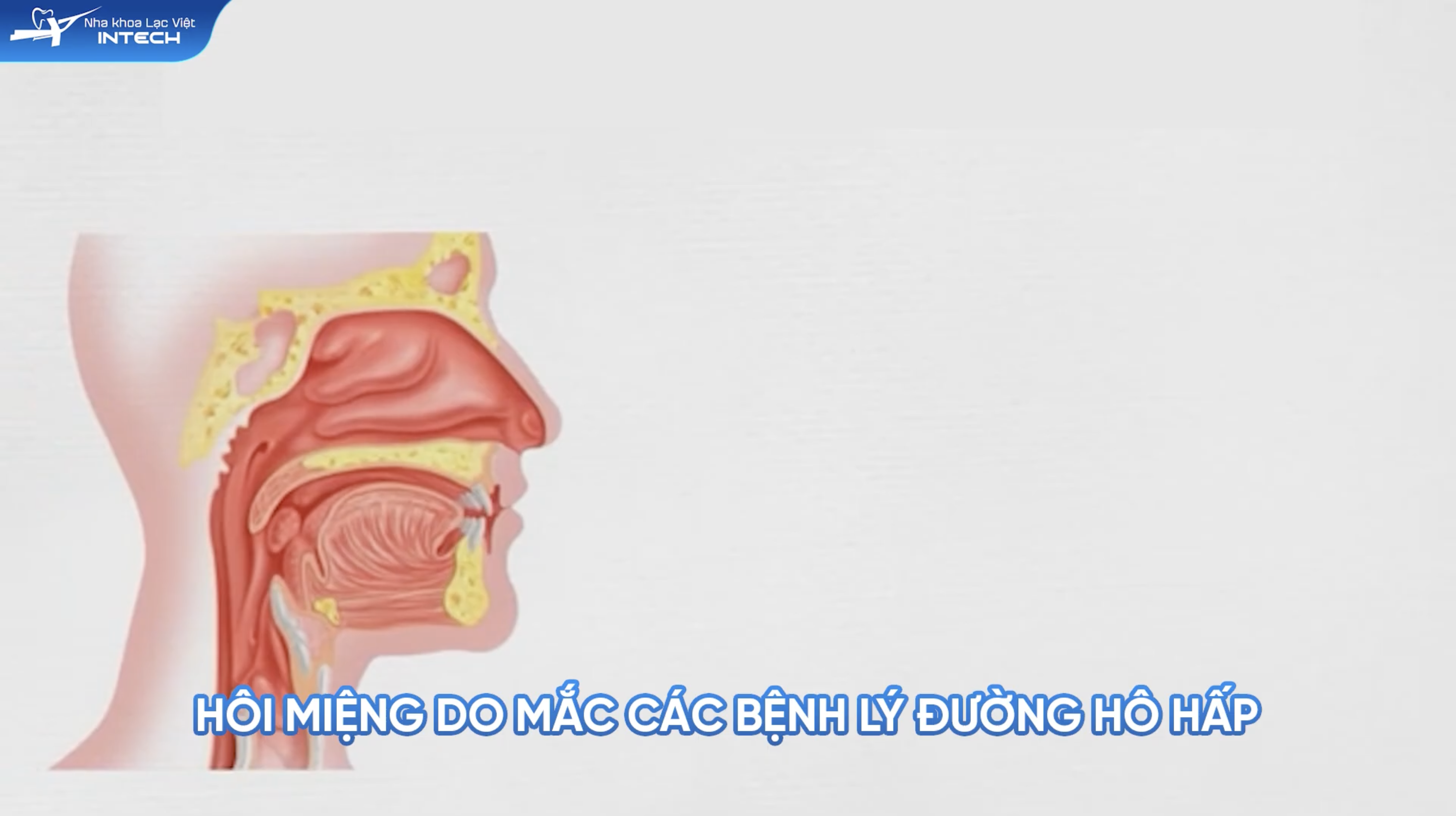 Các bệnh nhiễm trùng vùng hầu họng, viêm amidan, hoặc viêm xoang có thể là thủ phạm gây hôi miệng khi niềng răng