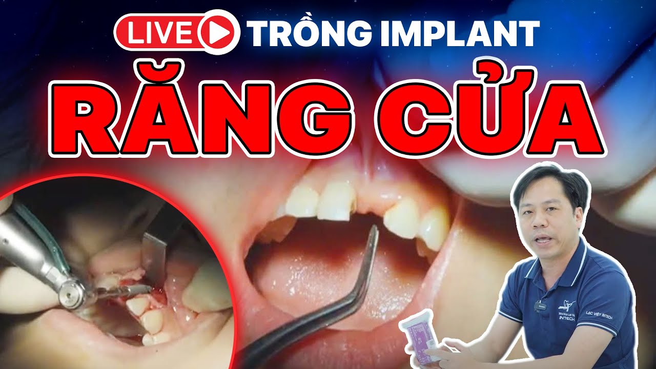 Trồng implant răng cửa: Quy trình chi tiết và review từ ca thực tế khách hàng