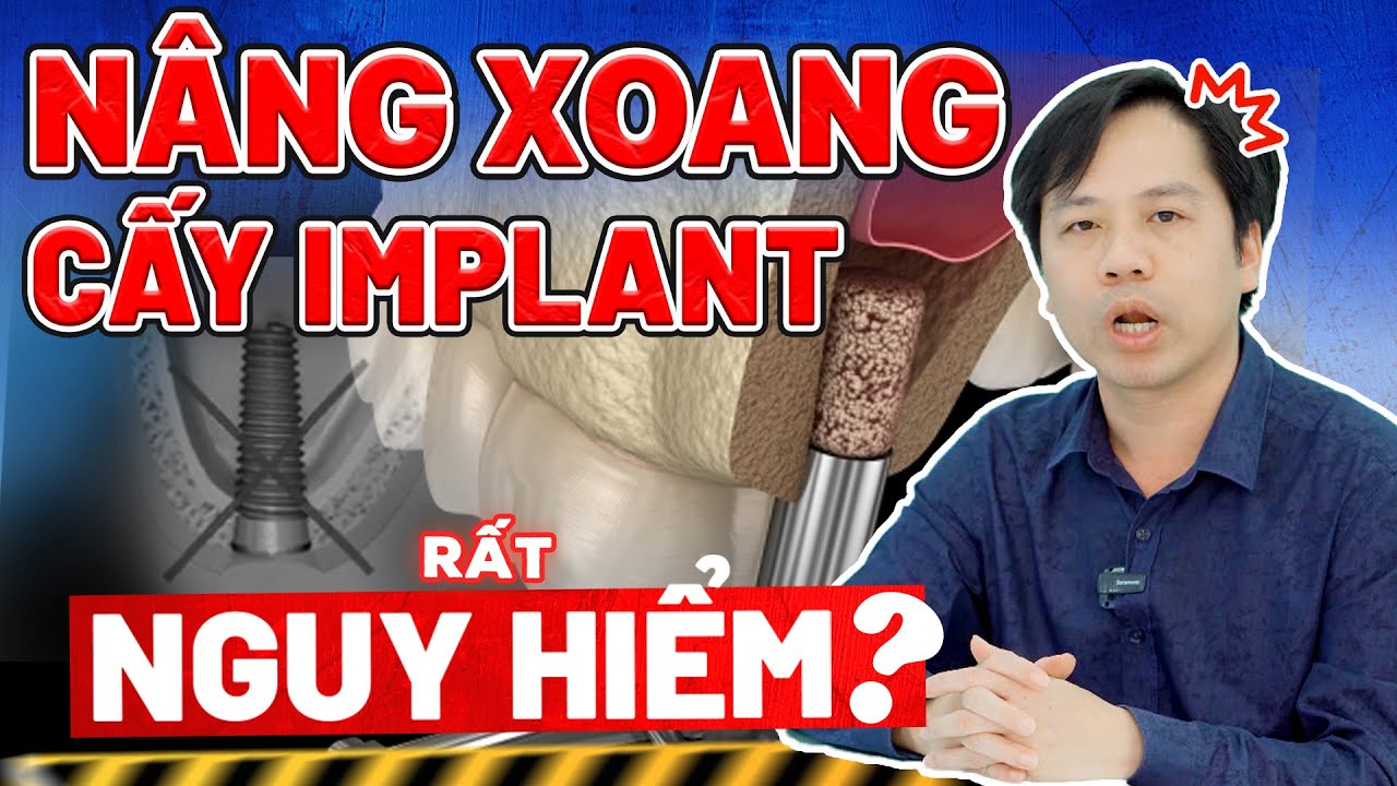 Nâng xoang khi cấy ghép Implant: 5 điều cần đặc biệt lưu ý trước khi làm