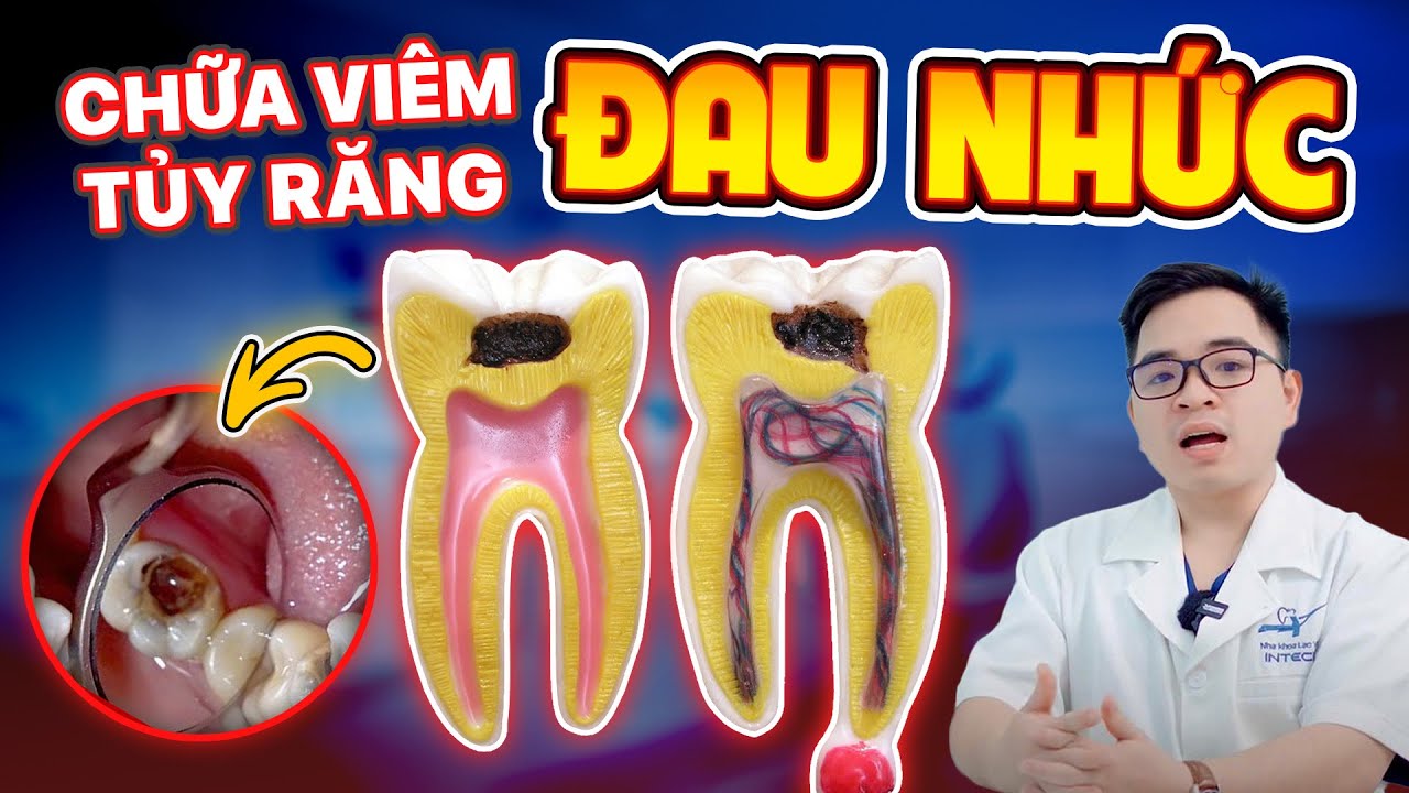 Viêm tủy răng: Cách điều trị dứt điểm cơn đau dai dẳng từ chuyên gia