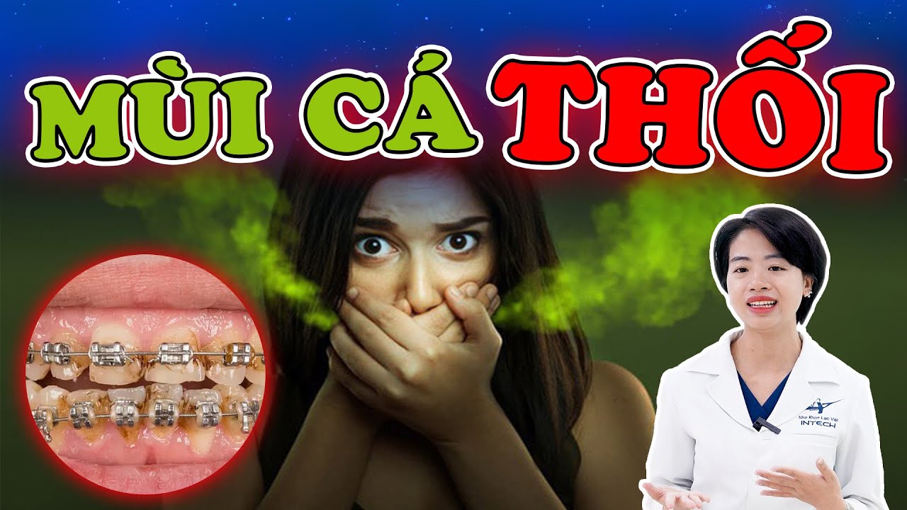 Hôi miệng khi niềng răng: 5 nguyên nhân và cách khắc phục hiệu quả