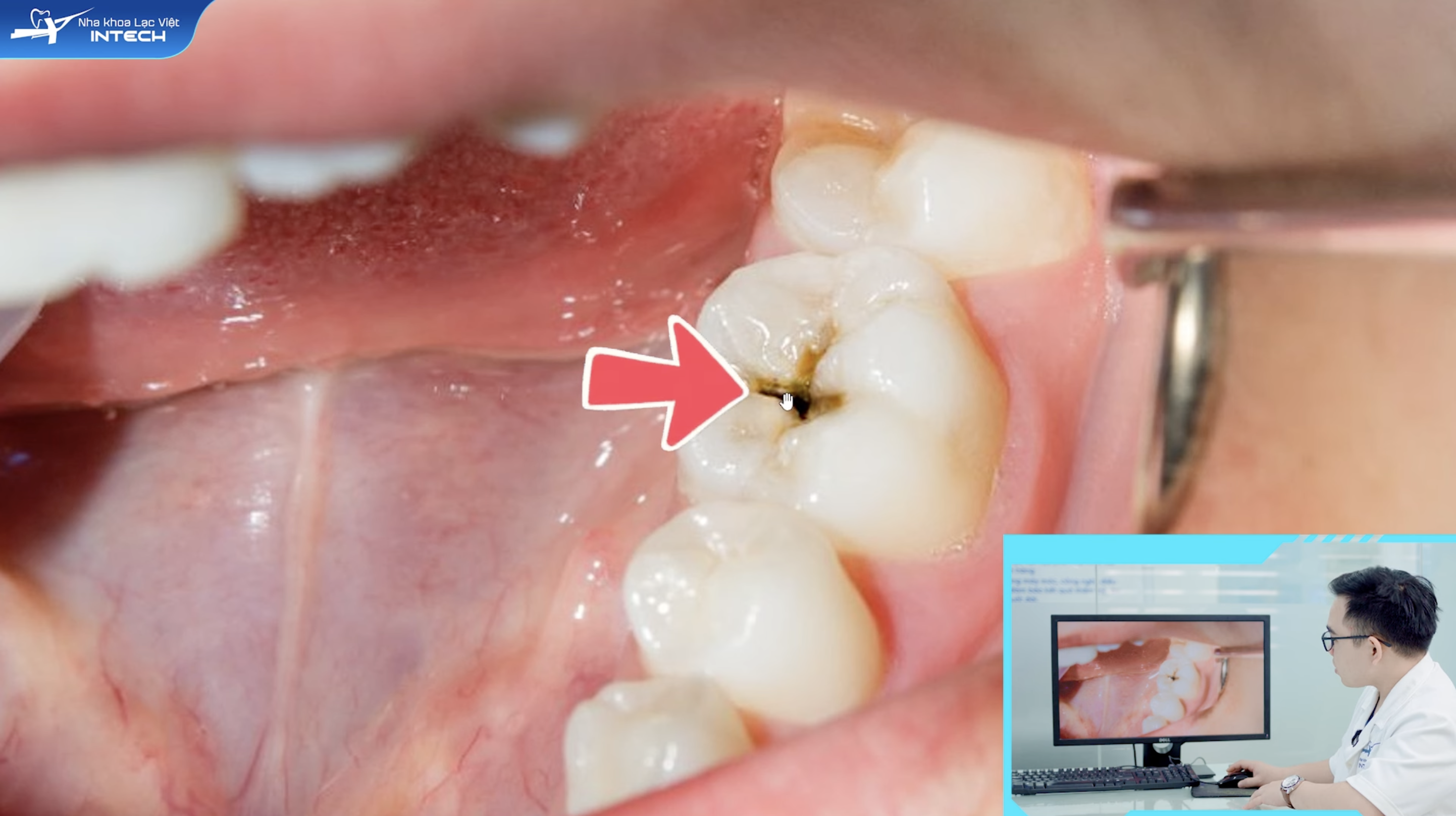 Viêm tuỷ có hồi phục khi có lỗ sâu nhỏ nhưng chưa ăn vào tuỷ