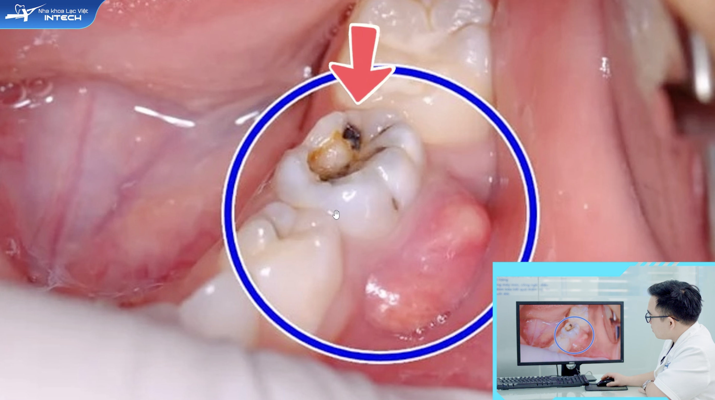 Viêm tuỷ hoại tử khi bệnh nhân có lỗ sâu lớn và ăn sâu vào tuỷ, răng có thể bị đổi màu và viêm quanh chóp
