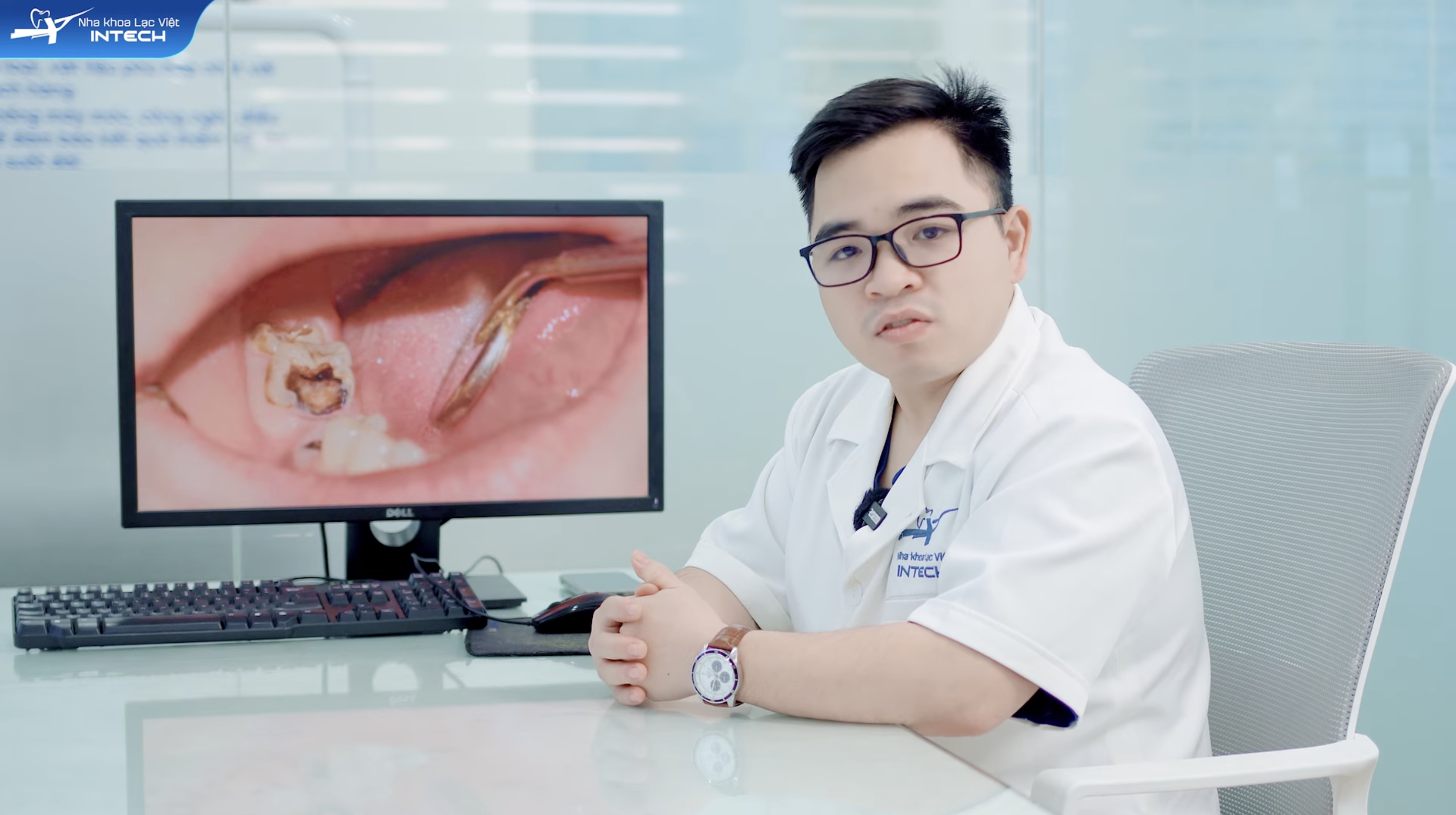 Viêm tuỷ không hồi phục khi bệnh nhân có lỗ sâu lớn, đã ăn vào tuỷ