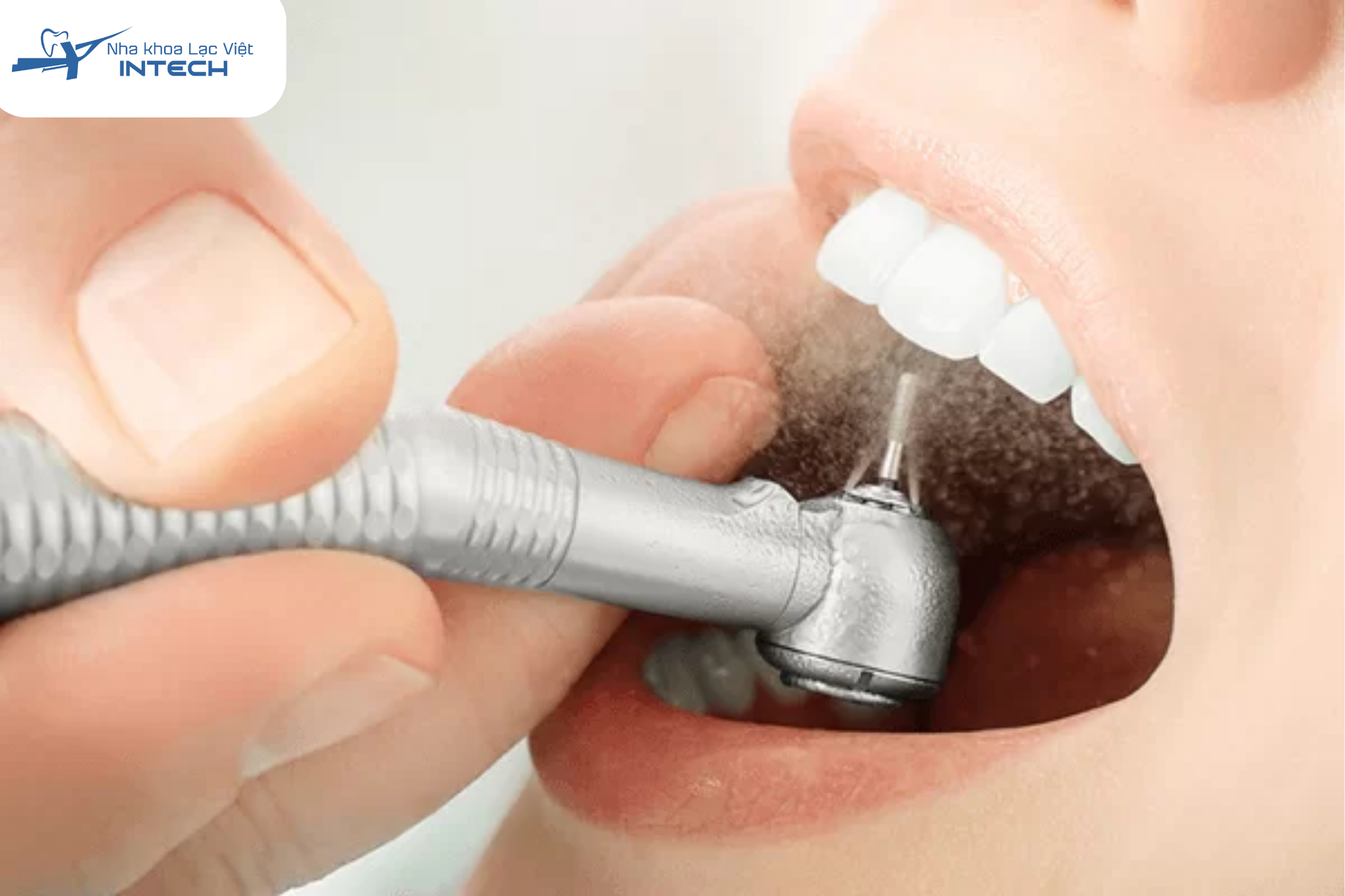 Lấy cao răng mảng bám là bước cơ bản và quan trọng nhất để loại bỏ nguyên nhân gây viêm