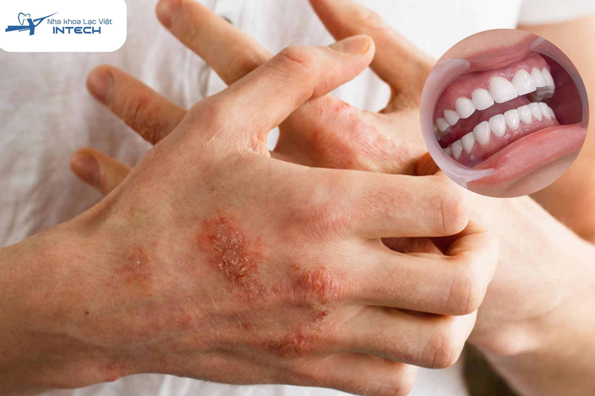 Dị ứng với chất liệu răng sứ hoàn toàn có thể xảy ra