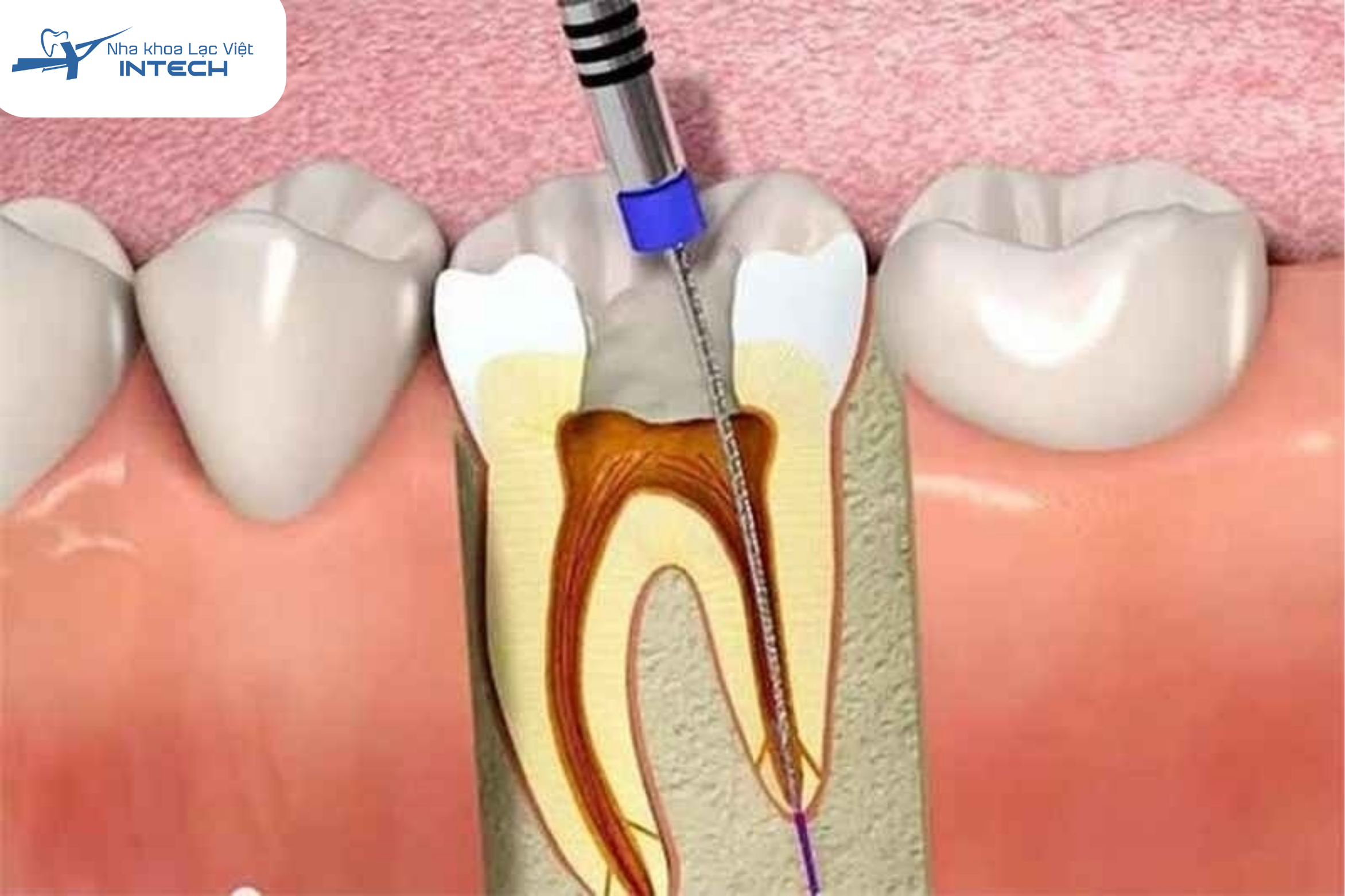 Điều trị tuỷ răng là phương pháp hiệu quả nhất để điều trị viêm tuỷ răng có mủ