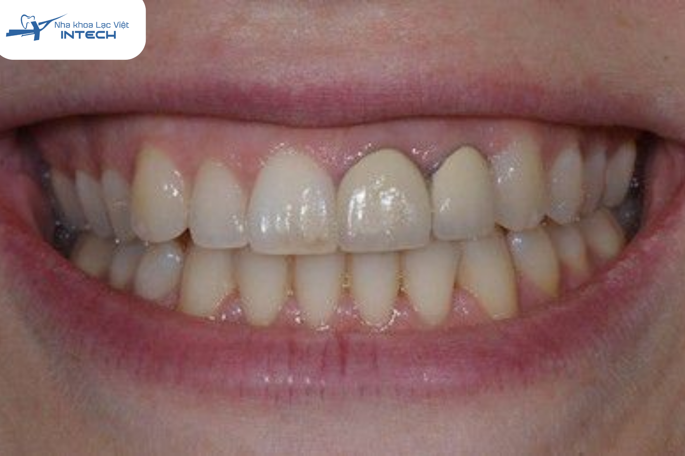 Răng sứ bị đen viền nướu sẽ cần tháo ra bọc lại