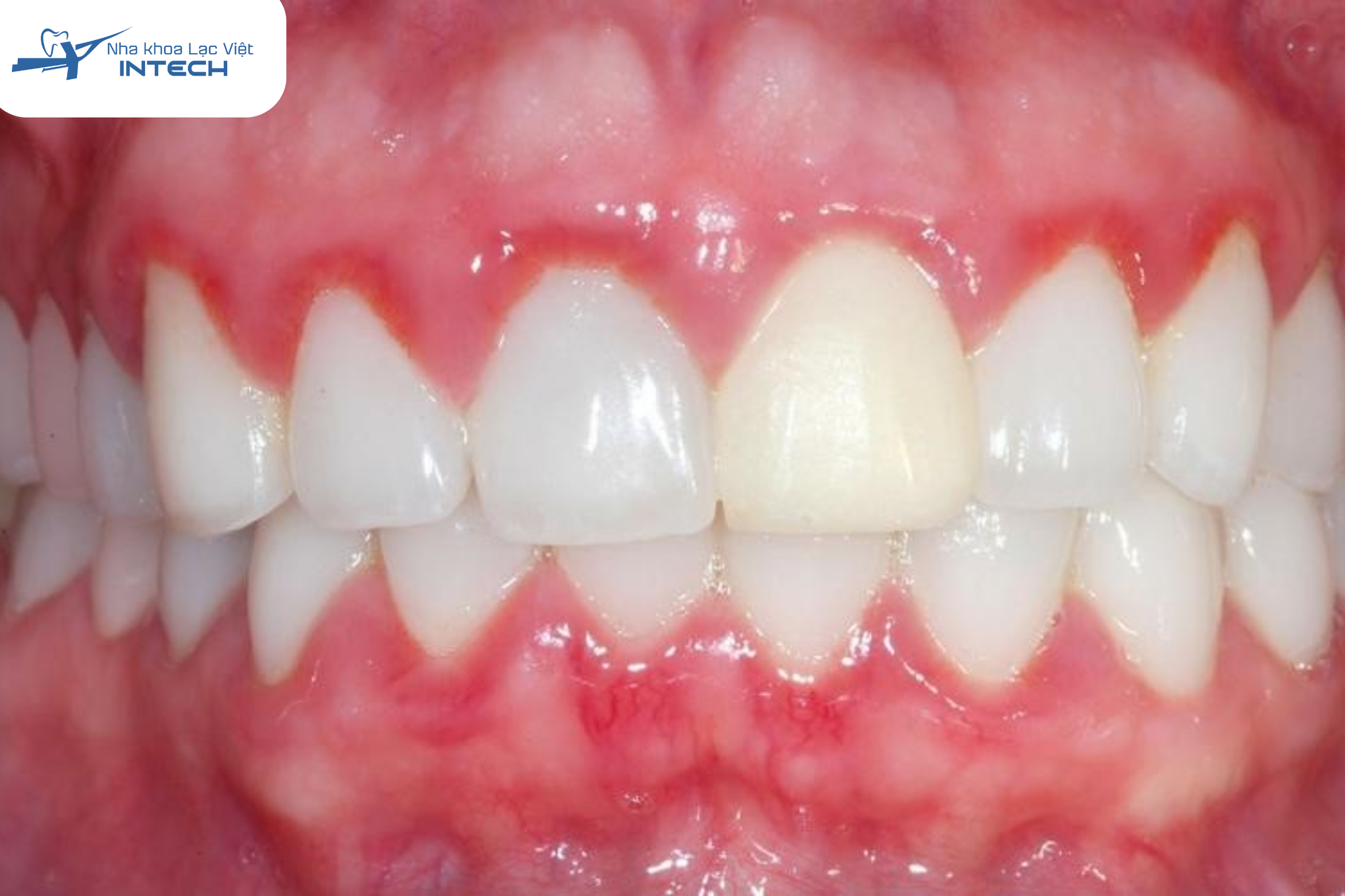 Giải pháp: Bác sĩ sẽ tháo răng sứ cũ, điều trị triệt để bệnh lý (như điều trị tủy, nạo sâu răng), sau đó mới tiến hành phục hình lại bằng mão sứ mới.