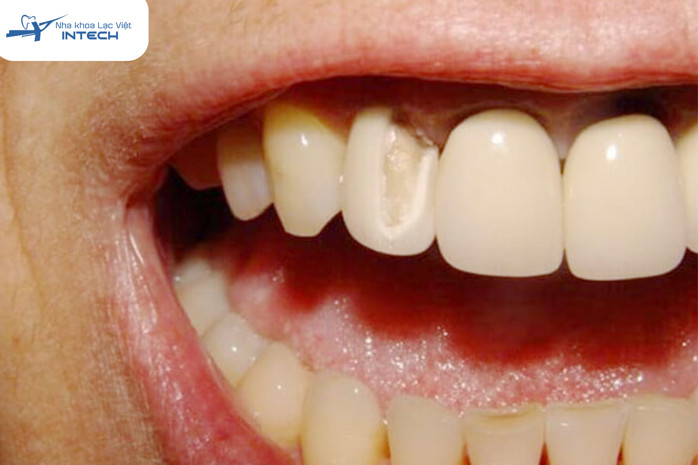 Răng sứ bị vỡ nứt do nhiều yếu tố sẽ cần tháo ra bọc lại