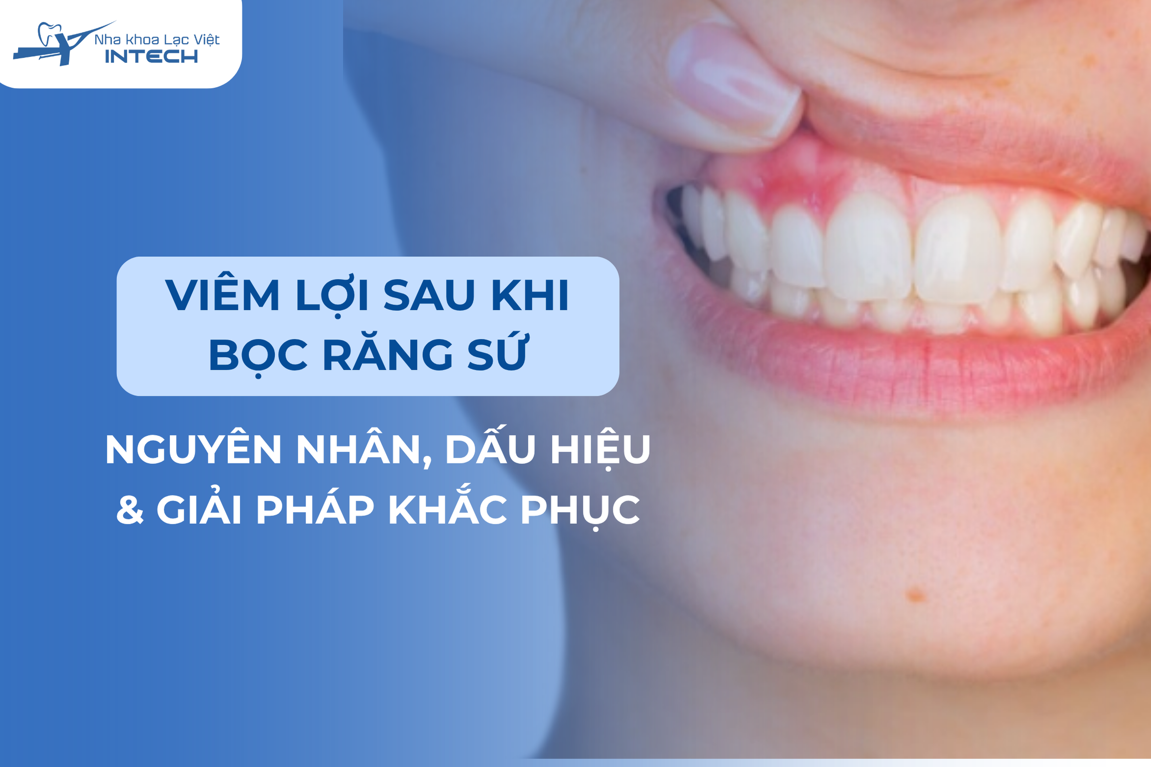 Viêm lợi sau khi bọc răng sứ: Nguyên nhân, dấu hiệu và giải pháp khắc phục