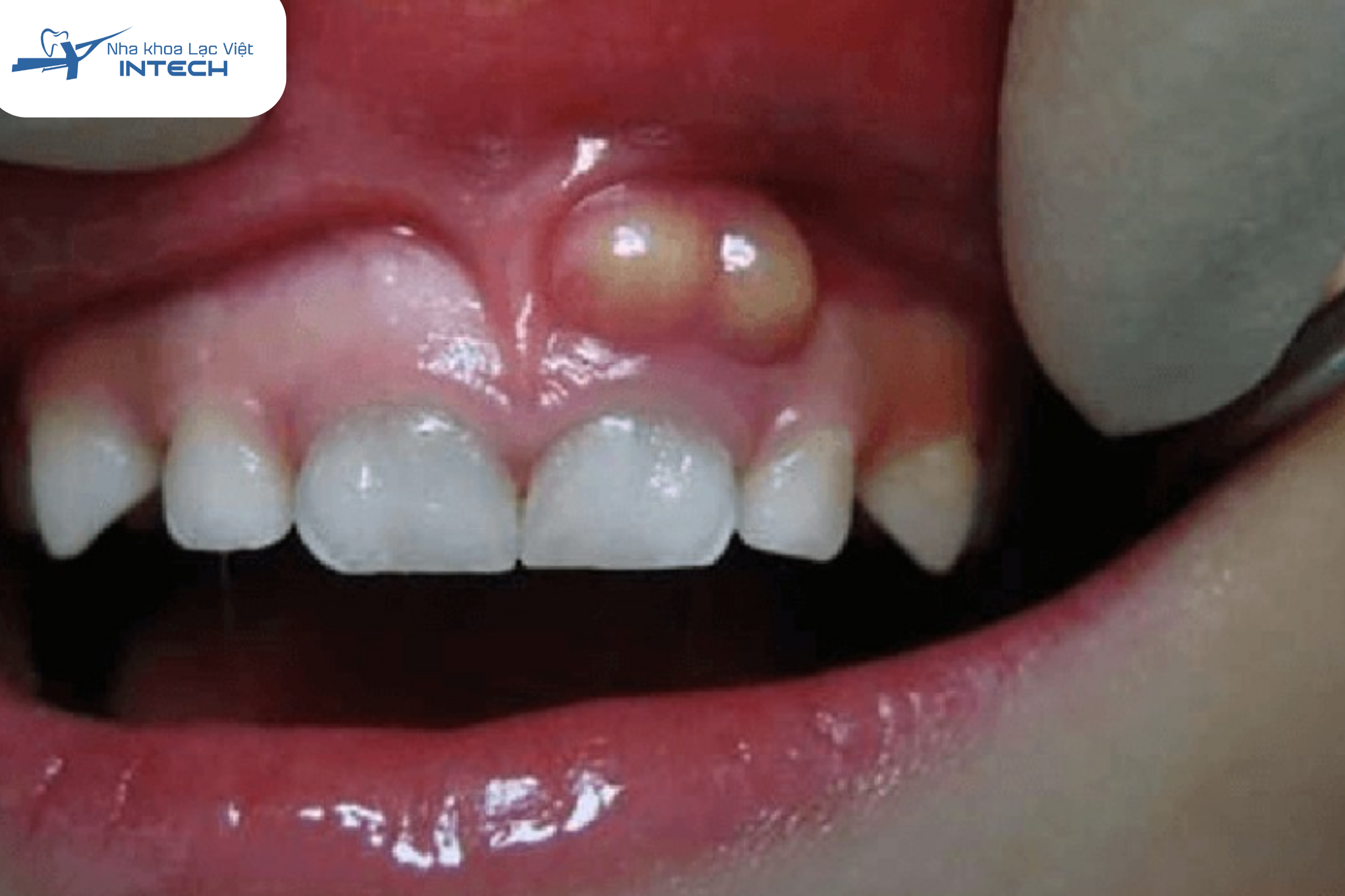 Viêm tuỷ răng có mủ cần được điều trị kịp thời để tránh những biến chứng sau này