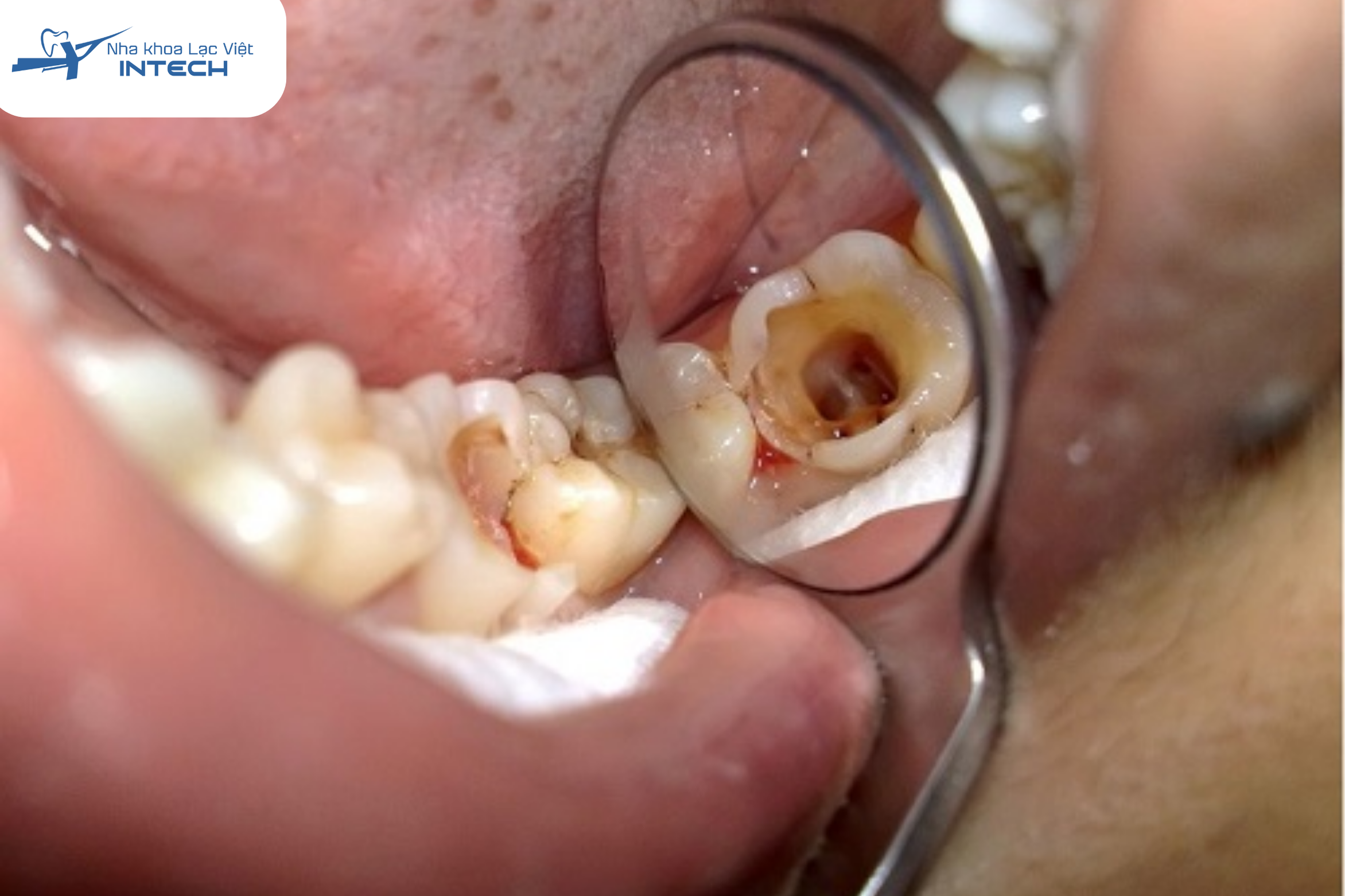 Ở giai đoạn viêm tuỷ răng không hồi phục điều trị tủy răng (lấy tủy) là phương pháp bắt buộc để loại bỏ mô tủy bị viêm nhiễm