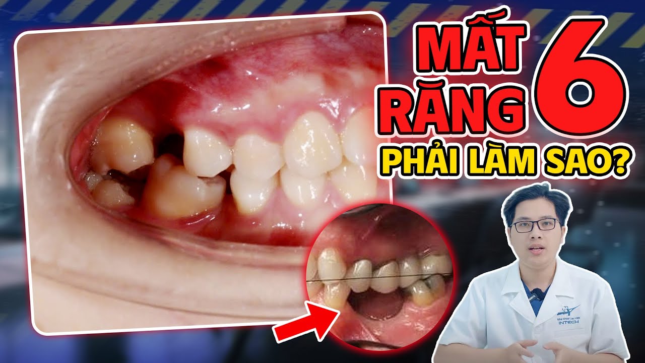 Mất răng 6 phải làm sao? Bác sĩ chỉ cách khắc phục ăn nhai chắc khỏe