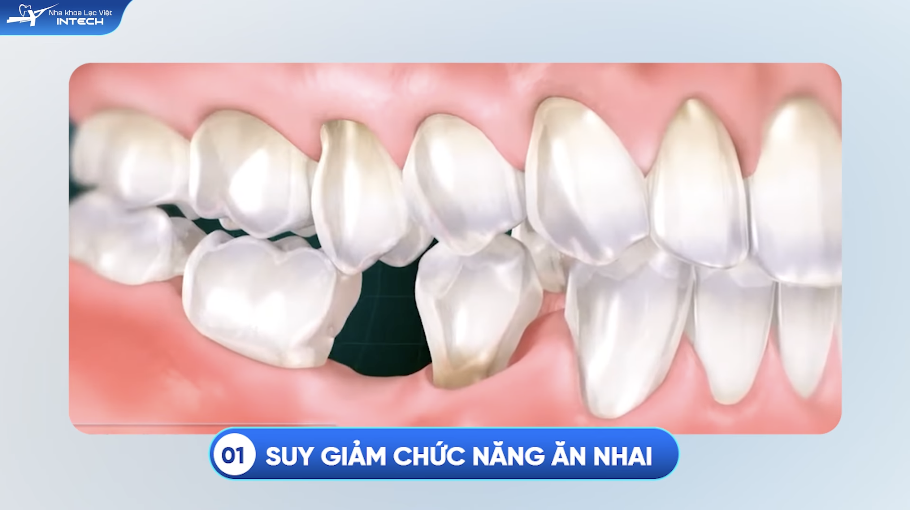 Khi răng này bị mất, toàn bộ hệ thống nhai sẽ mất cân bằng, khiến cô chú anh chị khó nghiền nát thức ăn kỹ như trước. 