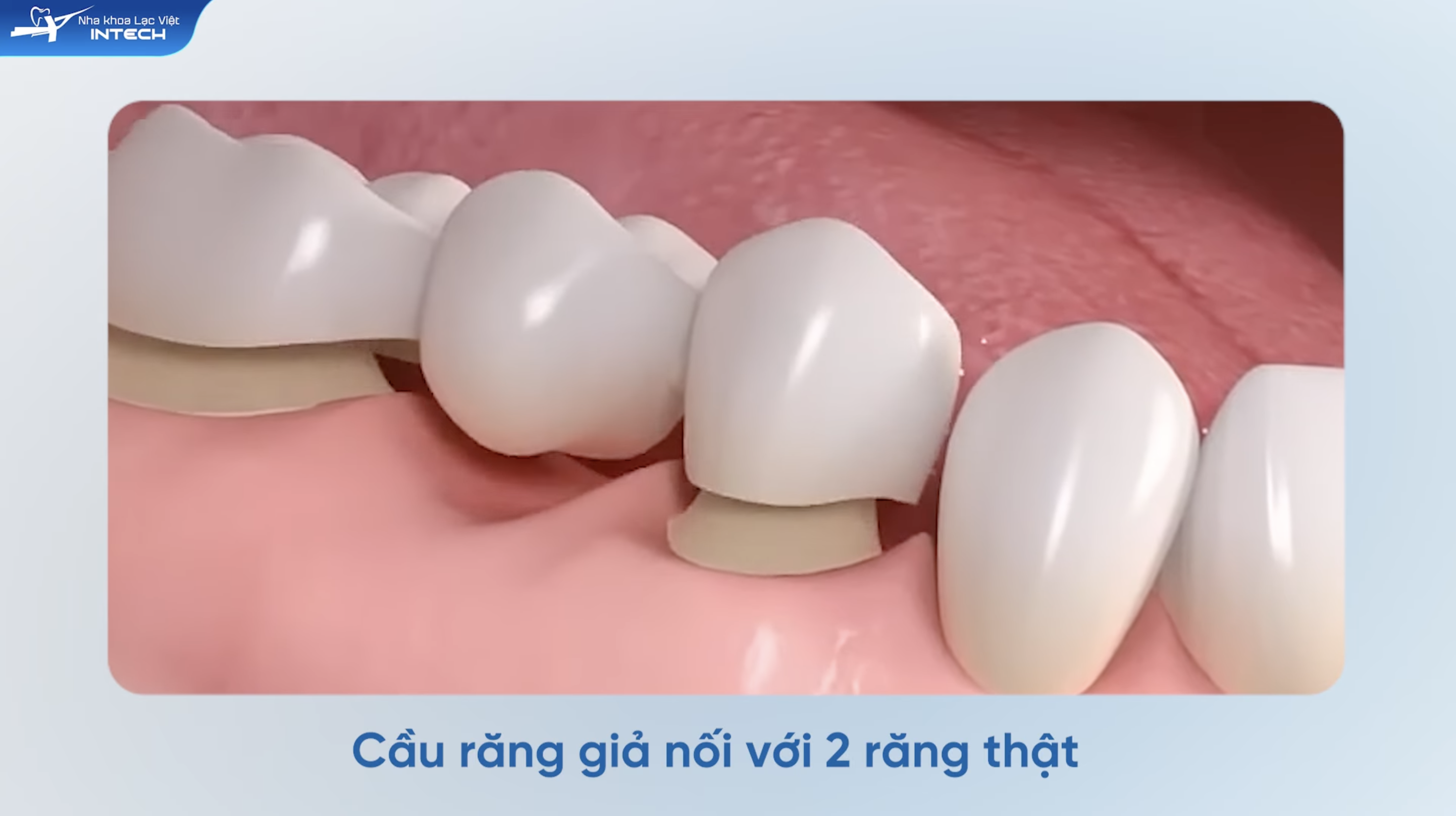 Theo bác sĩ Gia Bảo, cầu răng sứ chỉ nên xem là giải pháp tạm thời cho người chưa đủ điều kiện cấy Implant, chứ không nên duy trì lâu dài.