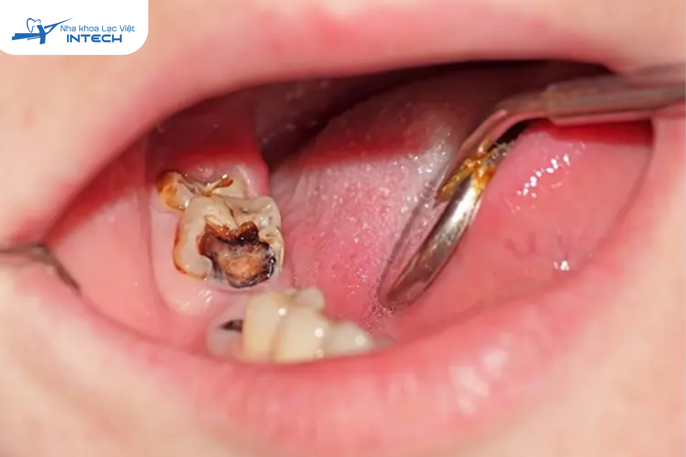 Khi vi khuẩn sâu răng đã phá huỷ tủy, răng trở nên yếu, dễ vỡ, nhiễm trùng chân răng và cuối cùng buộc phải nhổ bỏ.