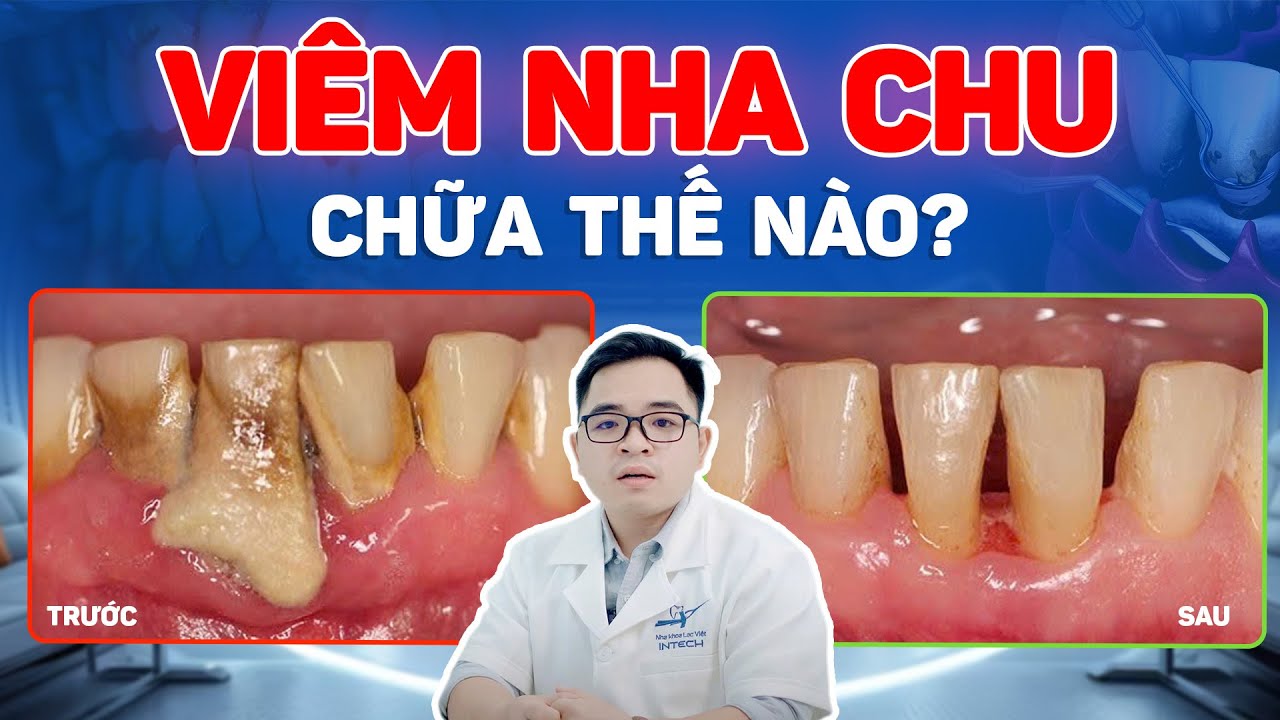 Chữa viêm nha chu nặng: Cách điều trị hiệu quả giúp giữ răng thật lâu dài